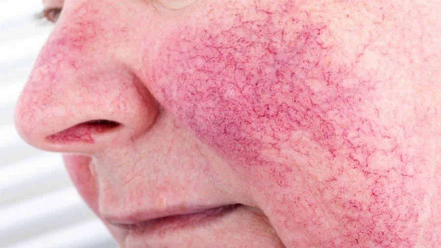 Close-up of a person's face with red, inflamed, and bumpy skin on the cheeks and nose, indicating skin irritation or rosacea.