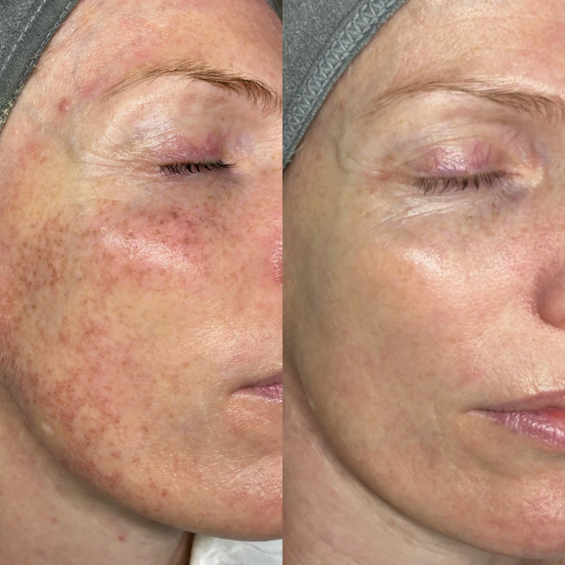 Close-up of a woman's face with visible acne, redness, and freckles, showing skin imperfections and textures.