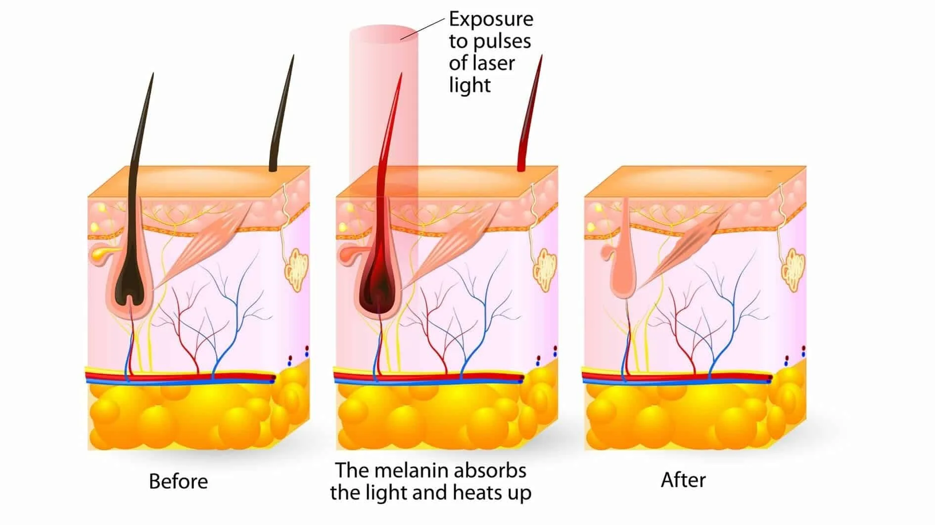 Diagram showing skin changes before, during, and after exposure to laser light, illustrating melanin absorbing light and heat, with labels 'Before', 'The melanin absorbs the light and heats up', and 'After'.