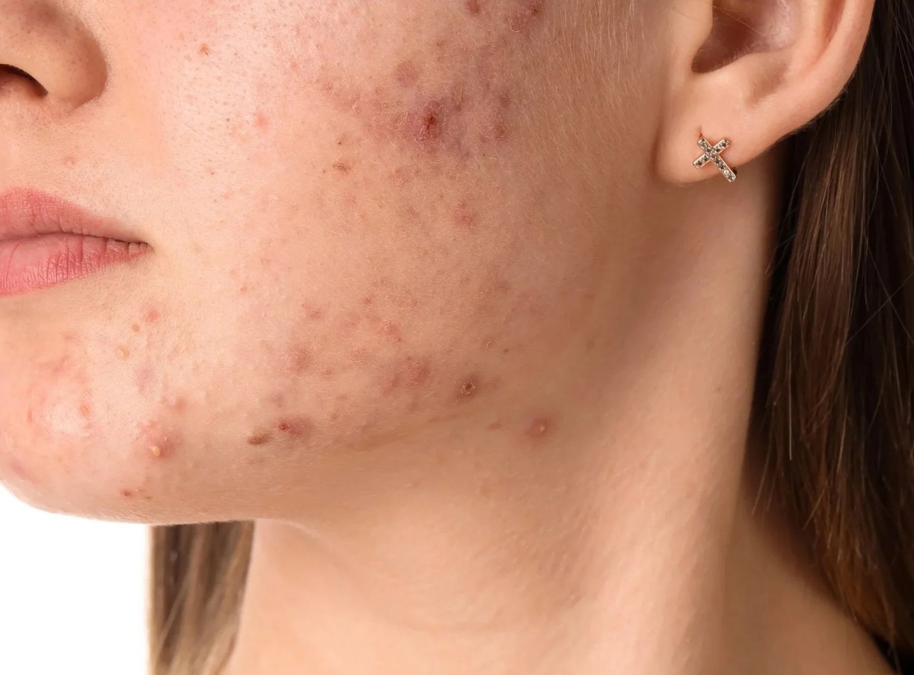 Acne image