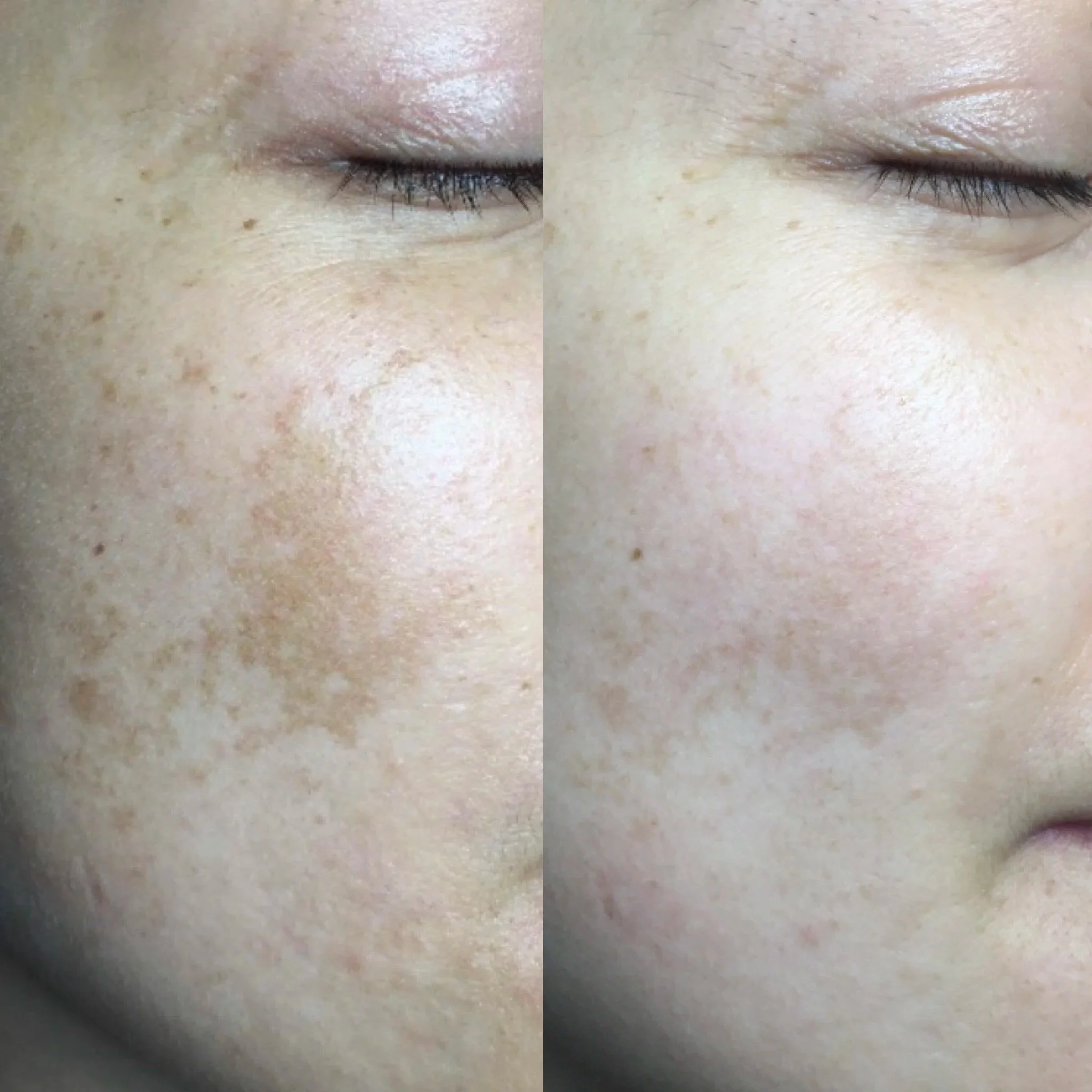 Close-up of a person's closed eye area showing small freckles and eyelashes, with a before and after comparison of skin appearance.