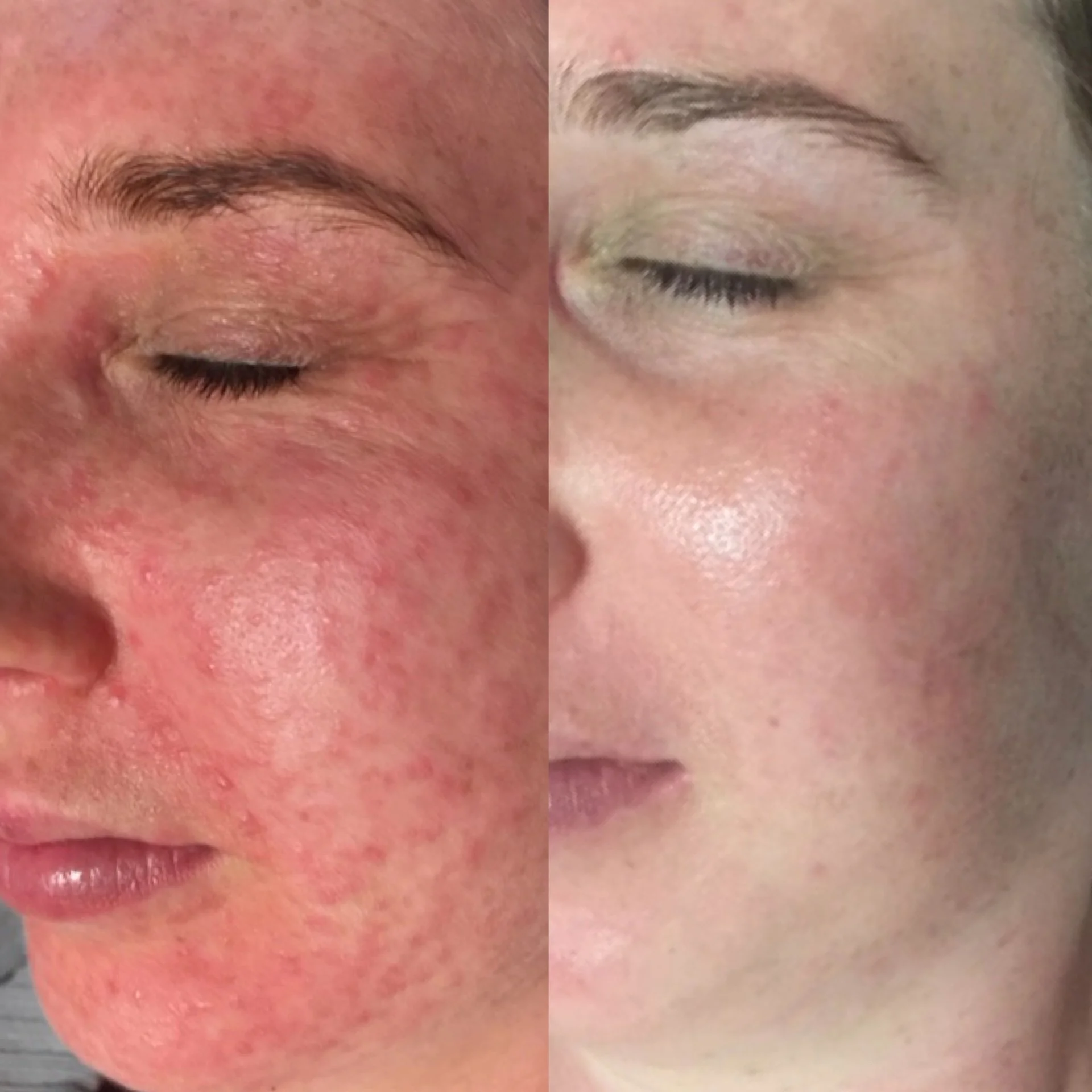 Close-up side-by-side comparison of a person's face before and after a skincare treatment, showing improved skin texture and complexion.