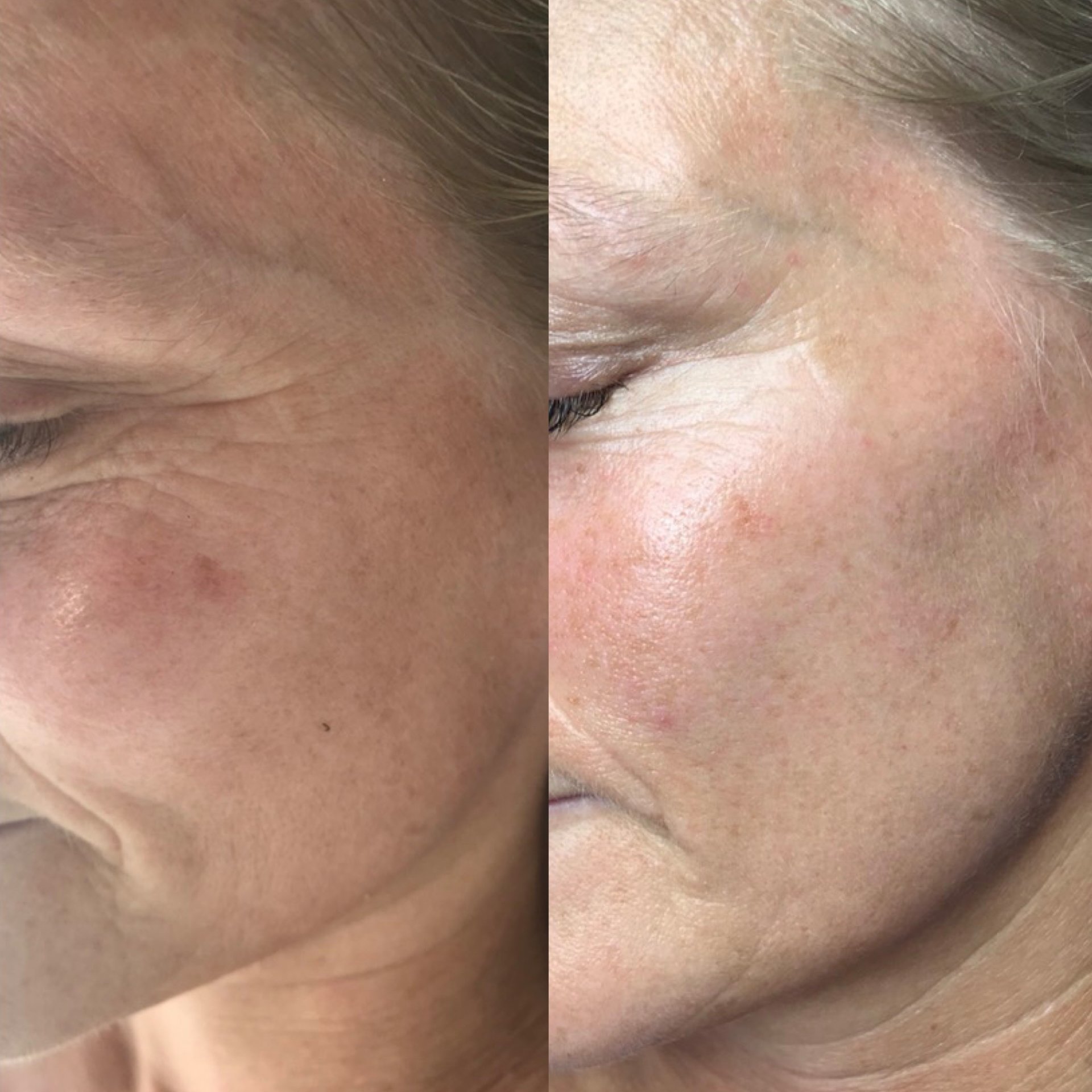 Close-up comparison of skin near the eye, showing a before and after of skin treatment with reduced wrinkles and improved skin texture.