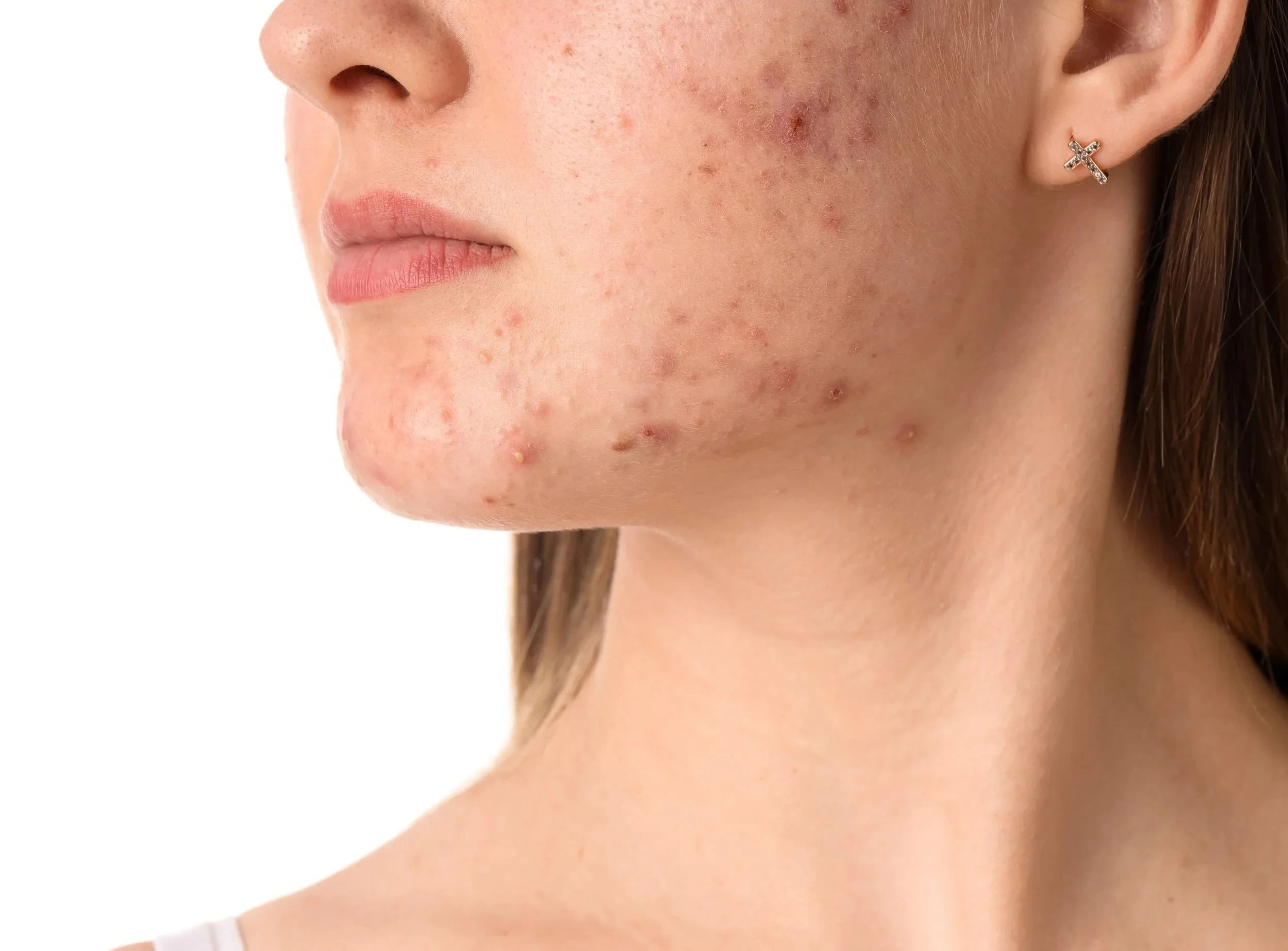 Close-up of a person's face showing acne and blemishes on the left cheek and jaw area.