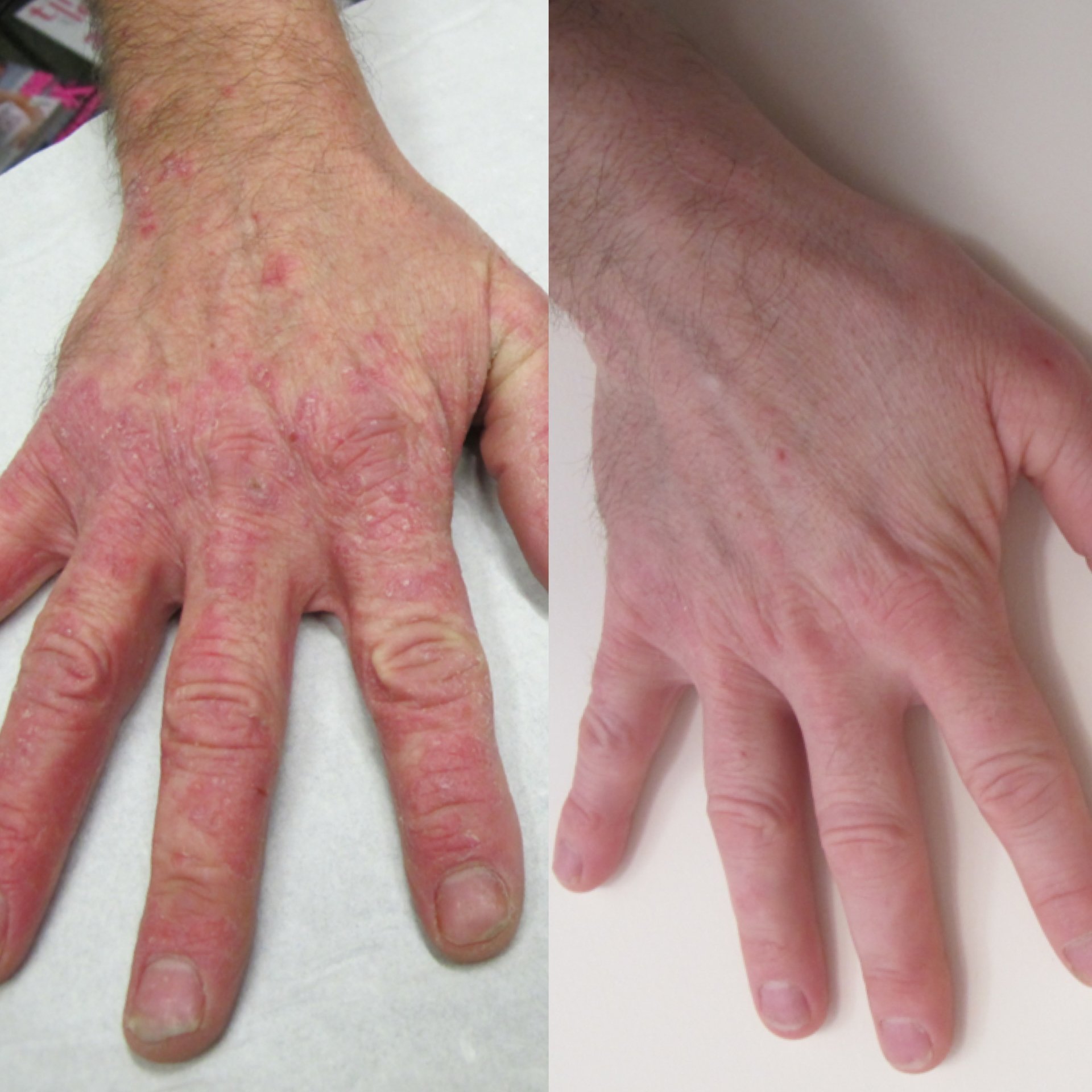 A side-by-side comparison of two hands, showing skin condition. The left hand has red, irritated, and rough skin with visible inflammation and patches. The right hand has smoother, clearer skin with less redness and irritation.