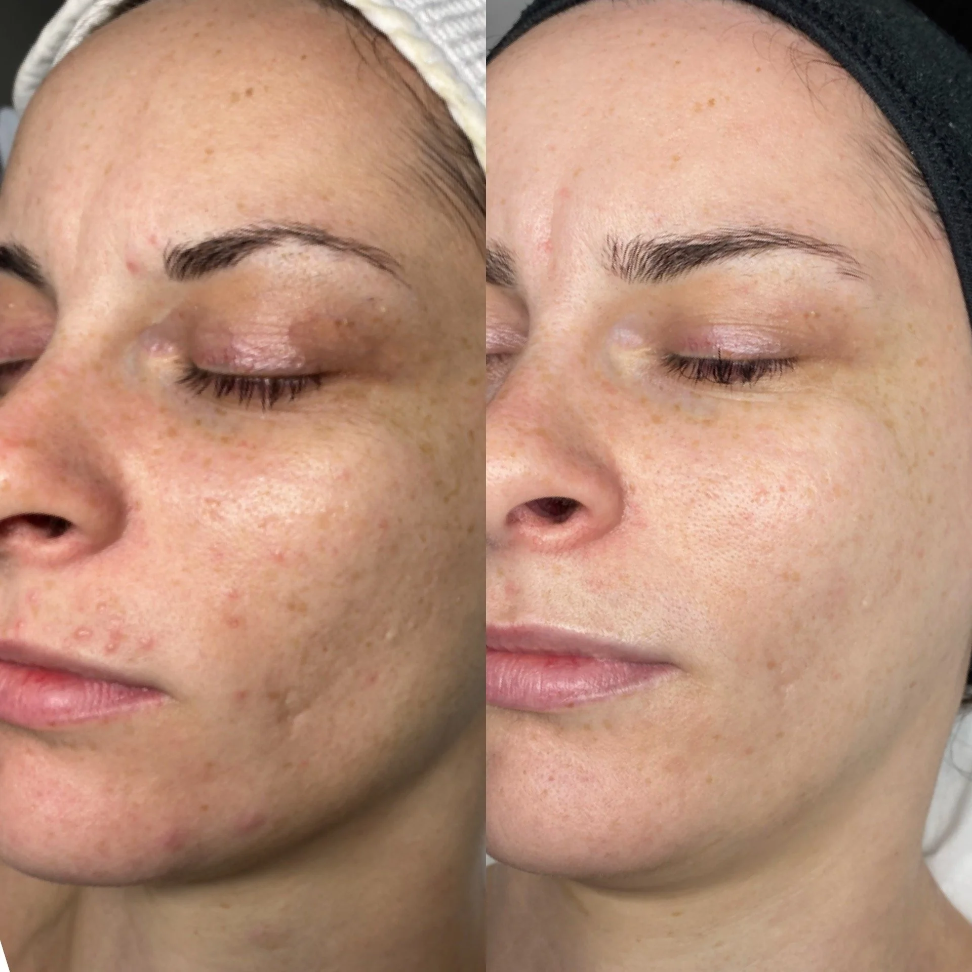 Comparison photo showing a person's face with visible freckles, uneven skin tone, and some spots on the left side, and clear, even skin on the right side after skincare or treatment.