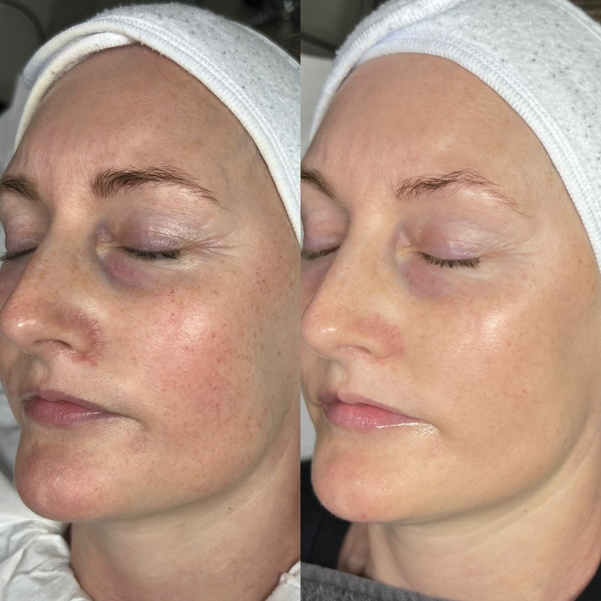 Close-up of a person's face with minimal makeup and visible skin imperfections, lying down with eyes closed, wearing a white headband.