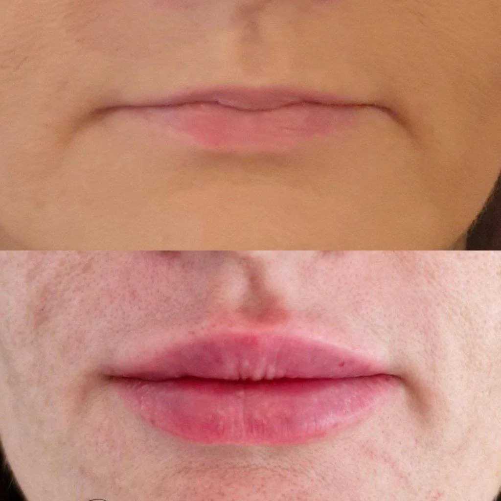 Close-up of a person's lips, showing two images with different lip conditions.