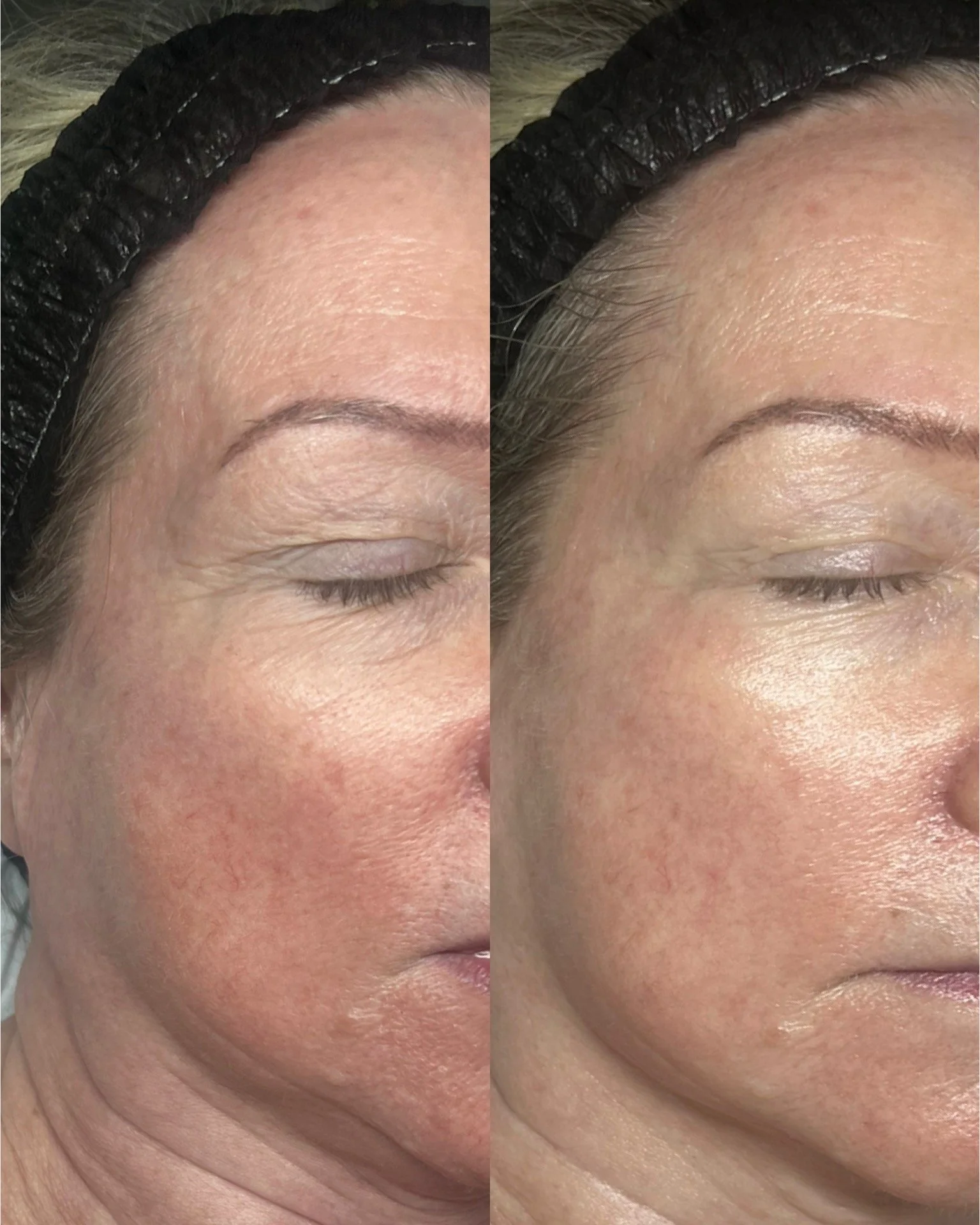 Close-up of a woman's face showing skin improvements after a skincare treatment, with visible reduction of redness and smoothing of skin texture.