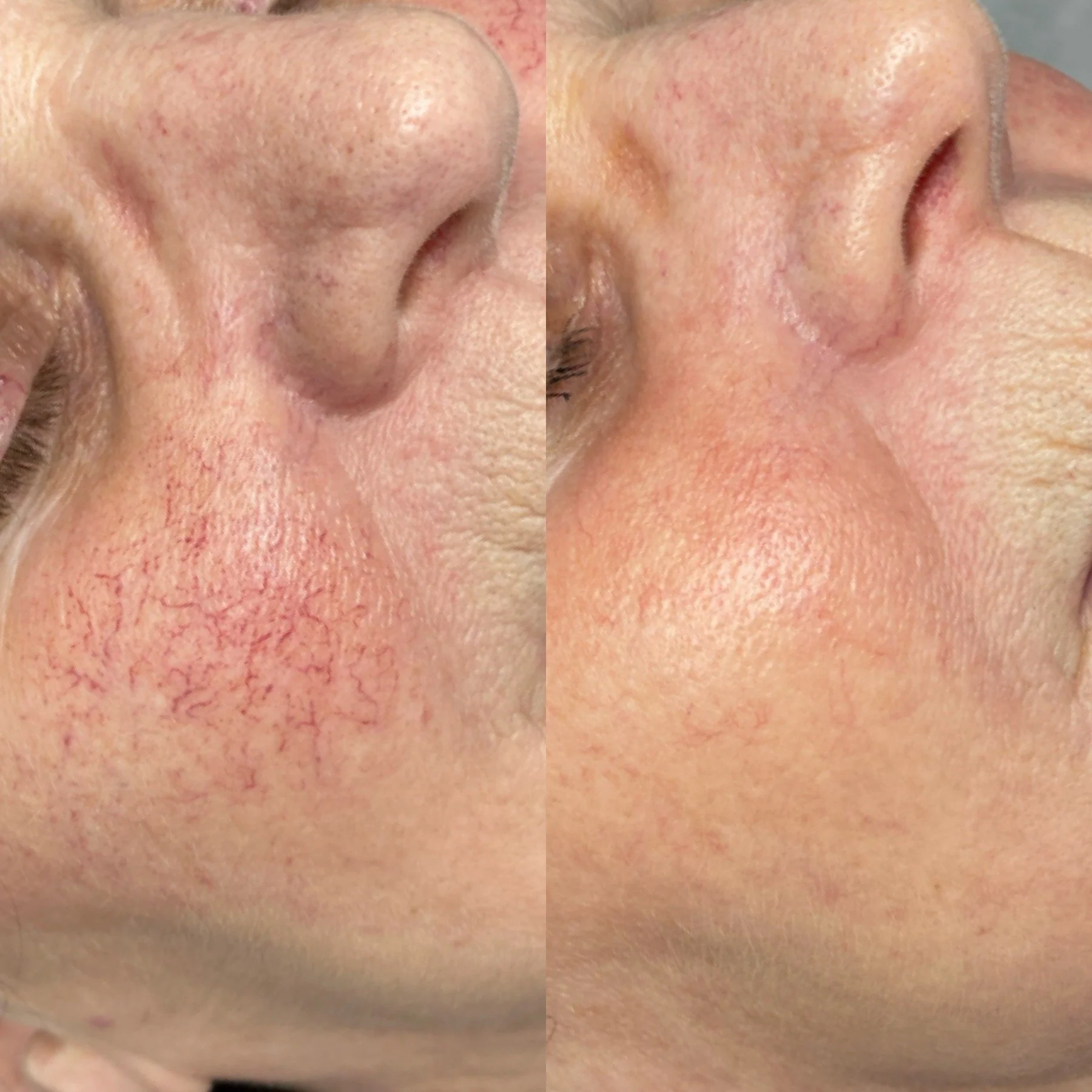 Close-up side-by-side comparison of a nose before and after a skin treatment, showing improved skin texture and reduced redness