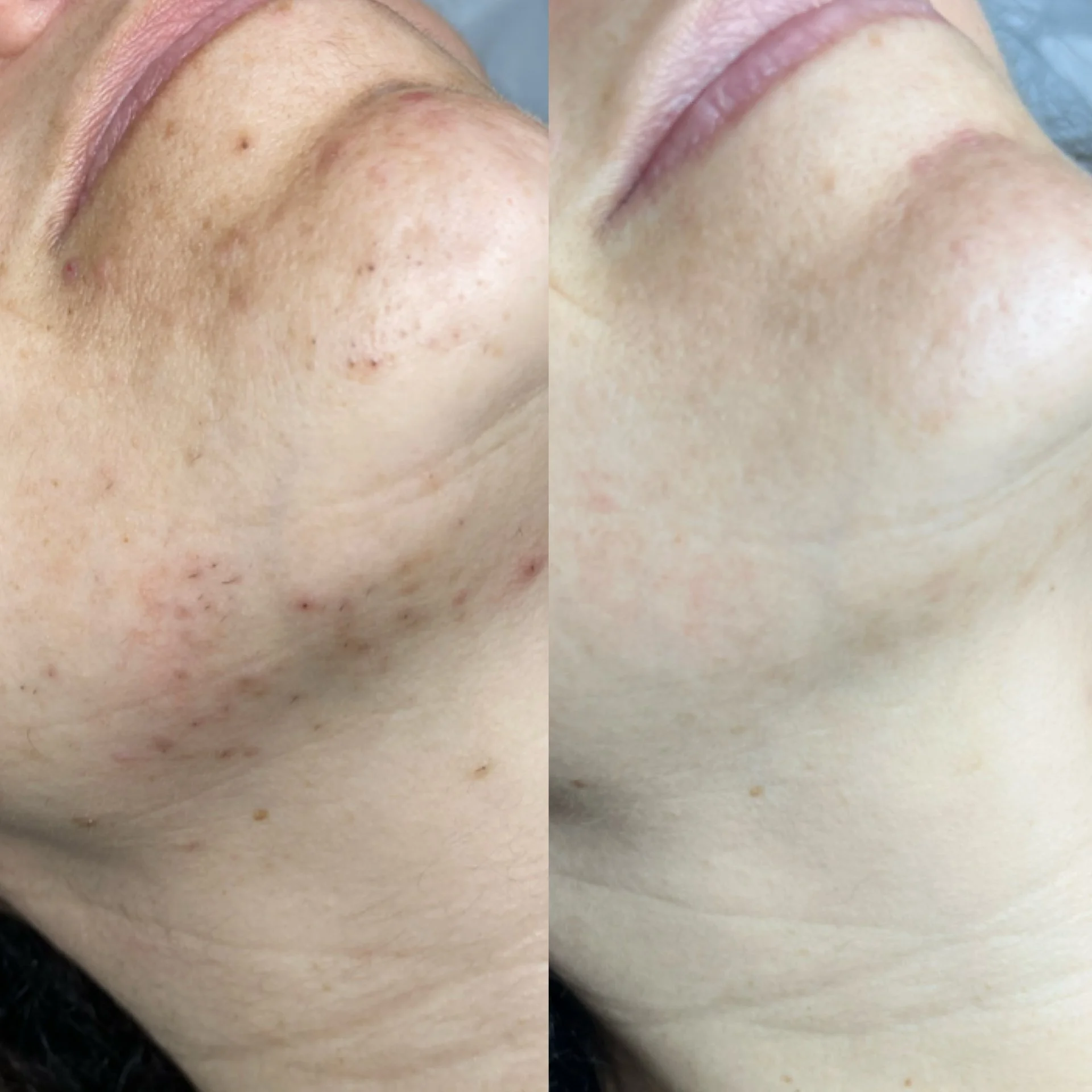 Close-up of a person's facial skin, showing before and after views of skin clearing or improvement, with reduced blemishes and smoother skin in the right image.