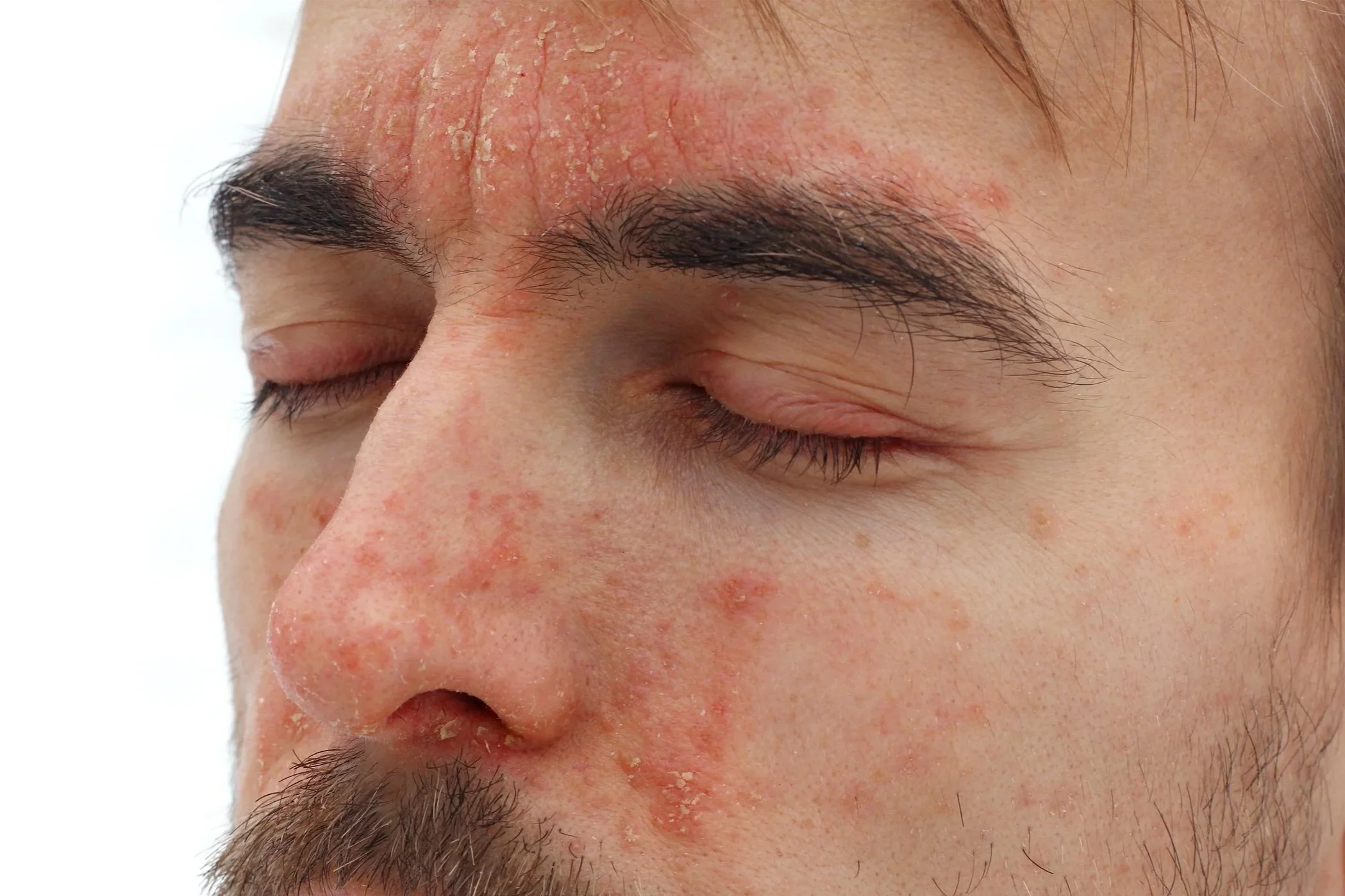 a man with eczema