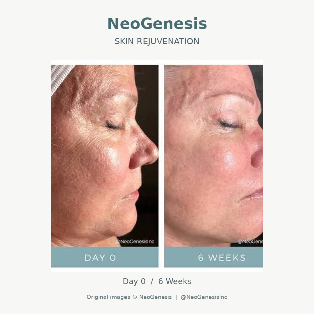 Comparison of a woman's face before and after a skincare treatment, showing improvement in skin texture and redness.