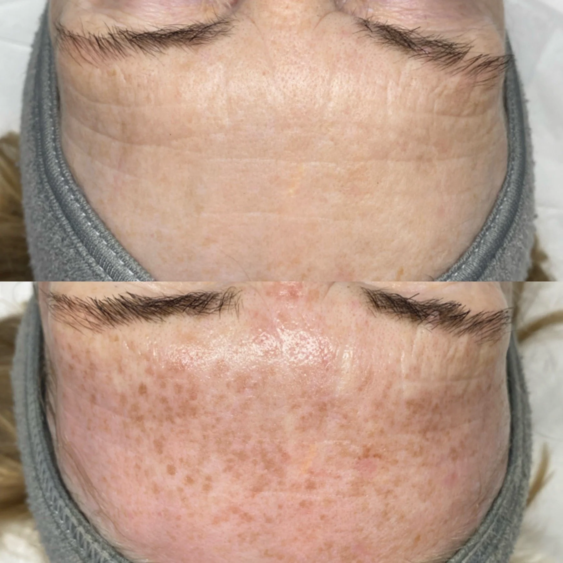 Close-up of a person's forehead and part of their eyebrows with a gray hoodie visible.