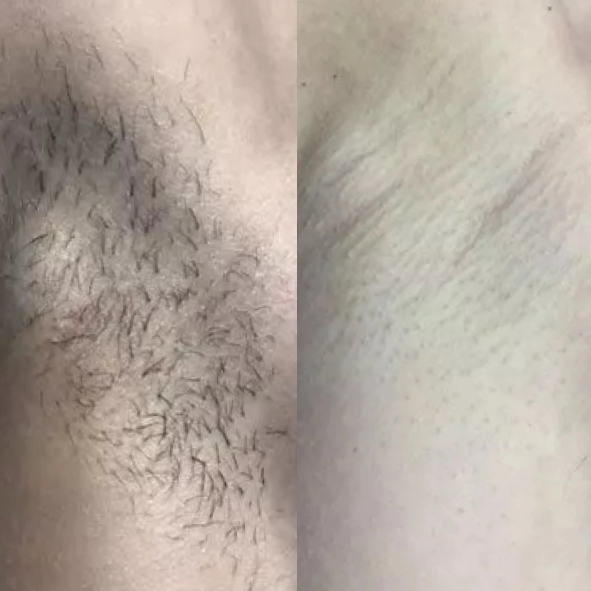 Close-up of skin with hair and a comparison of hair growth or removal.