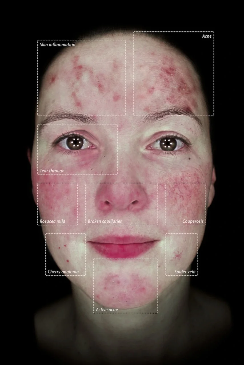A woman's face showing various skin conditions labeled: skin inflammation and acne on the forehead, tear trough under the eyes, rosacea mild, broken capillaries, and couperosis on the cheeks, cherry angioma on the lower cheek, active acne on the chin, and spider vein on the jawline.
