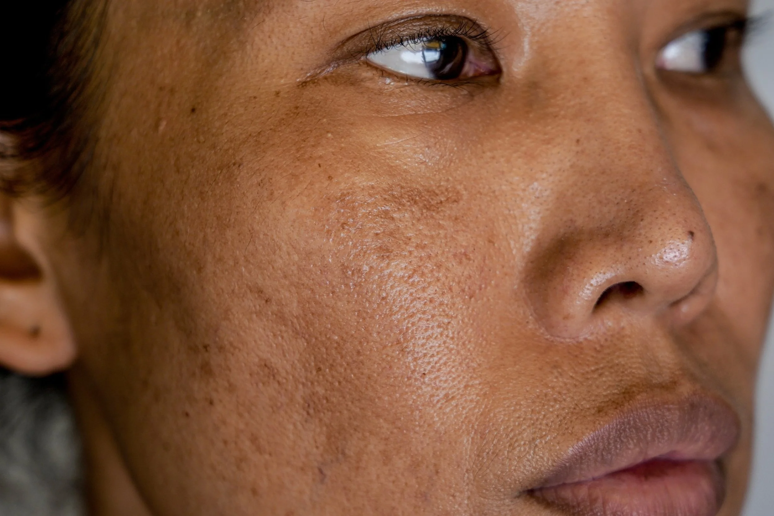 Close-up of a person's face focusing on their eye, nose, and surrounding skin with visible freckles.