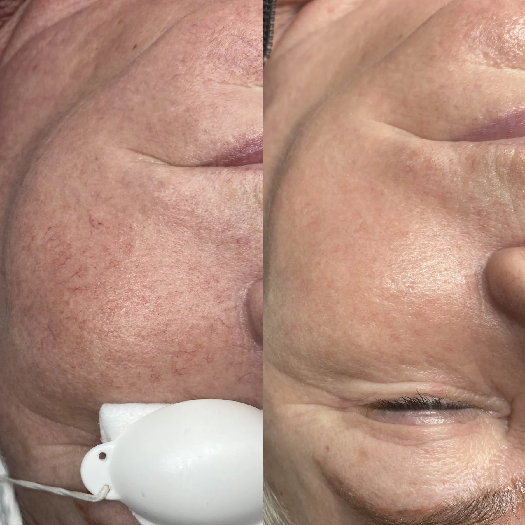 Close-up comparison of a person's facial skin before and after treatment showing improved skin texture and reduced redness.