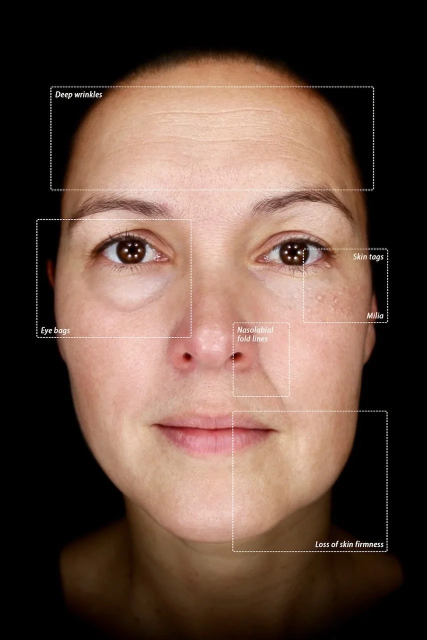 Close-up portrait of a woman with labeled skin features: deep wrinkles on the forehead, skin tags near the right eye, milia spots under the right eye, eye bags under both eyes, nasolabial fold lines, and loss of skin firmness on the cheeks.