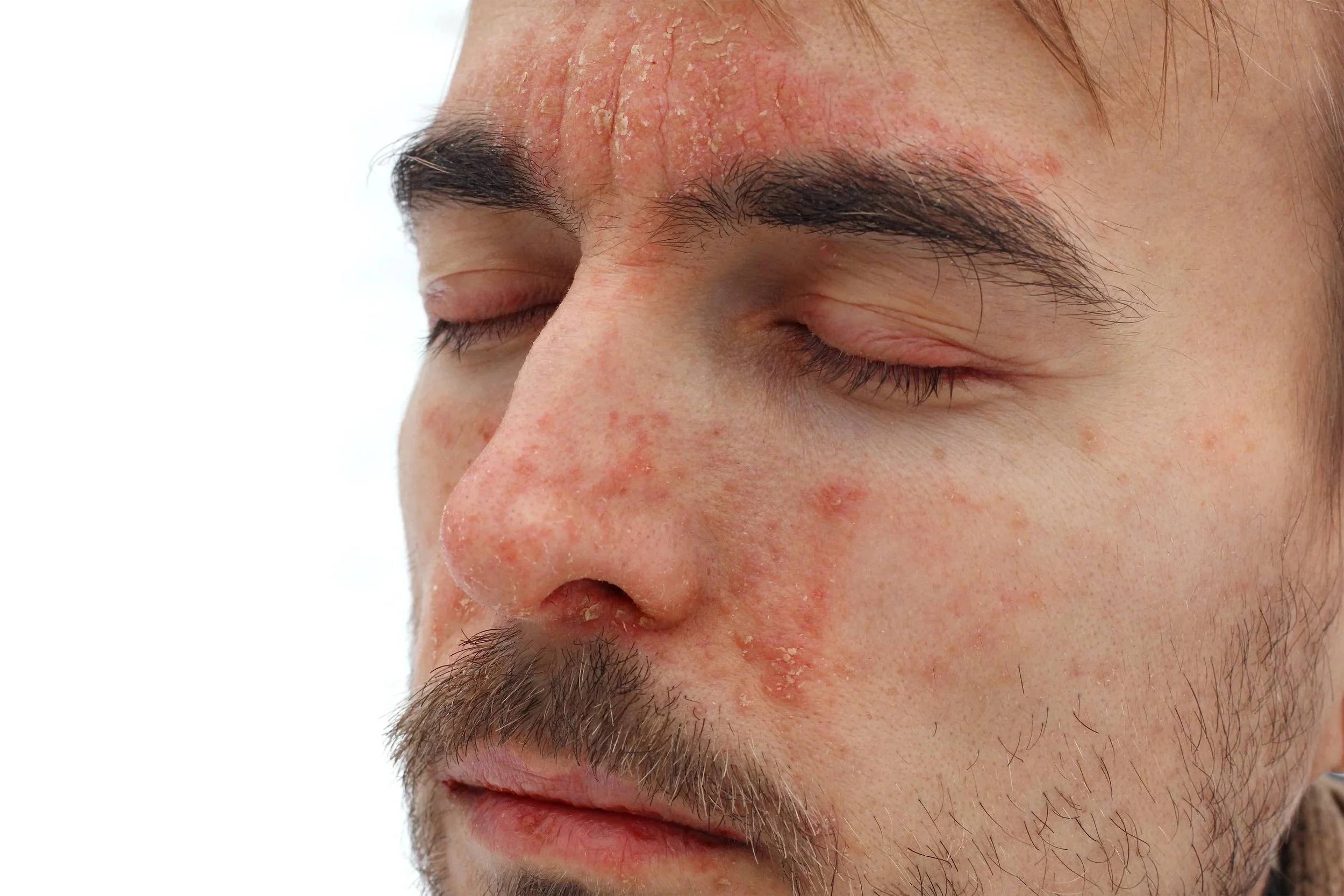 Close-up of a man's face with red, inflamed skin and dry patches on his forehead, nose, and cheeks, with eyes closed.