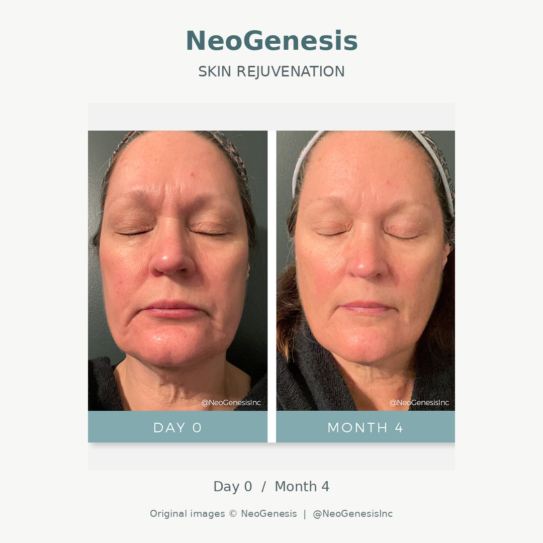 Close-up side-by-side comparison of an elderly person's face before and after cosmetic treatment, showing smoother skin and fewer wrinkles.