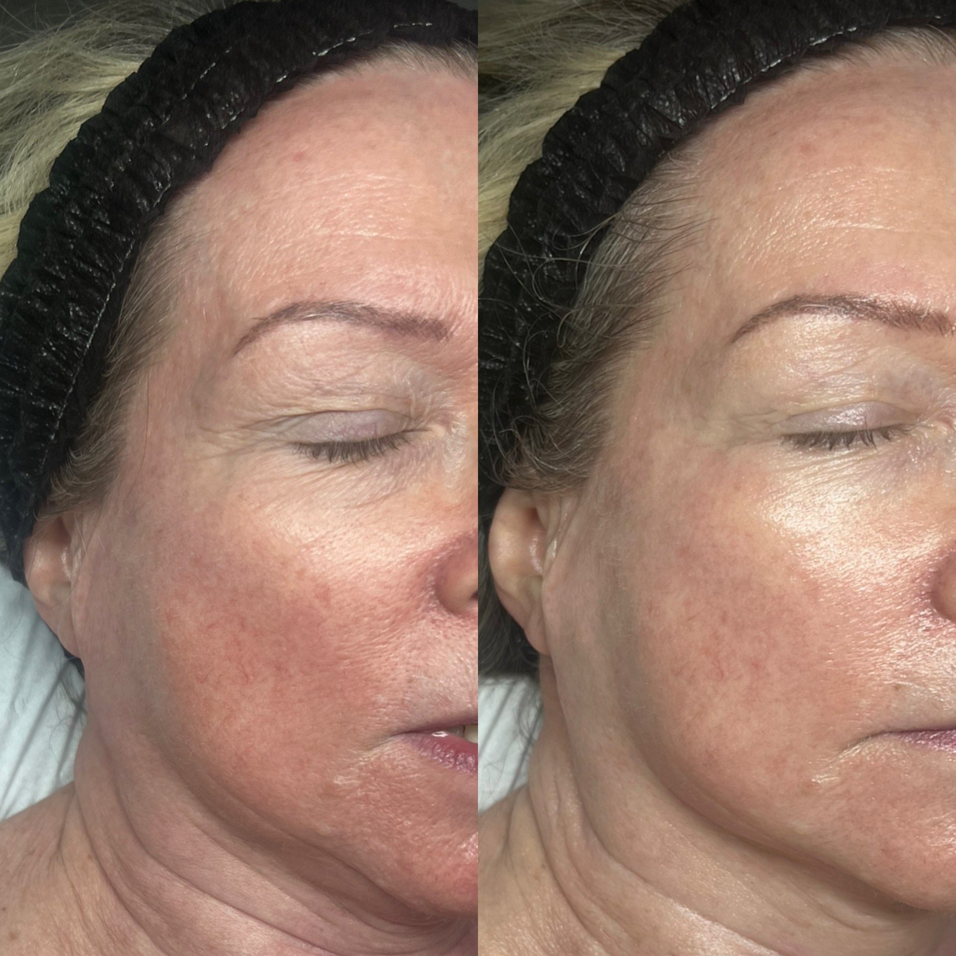 Close-up of a woman's forehead, showing a before and after comparison of skin improvement, with her wearing a black headband.