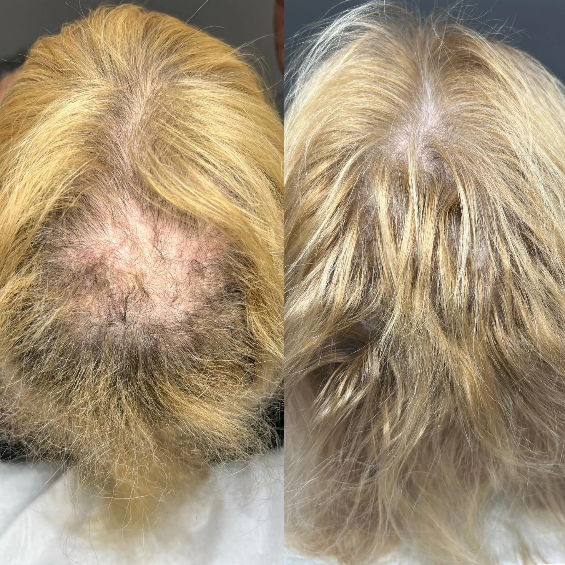 Comparison of scalp hair before and after treatment showing reduction in hair thinning and increased hair density