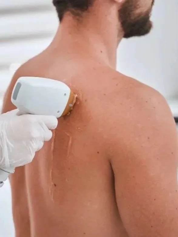 A person receives a medical or cosmetic treatment on their back from a healthcare professional wearing gloves, using a handheld device.