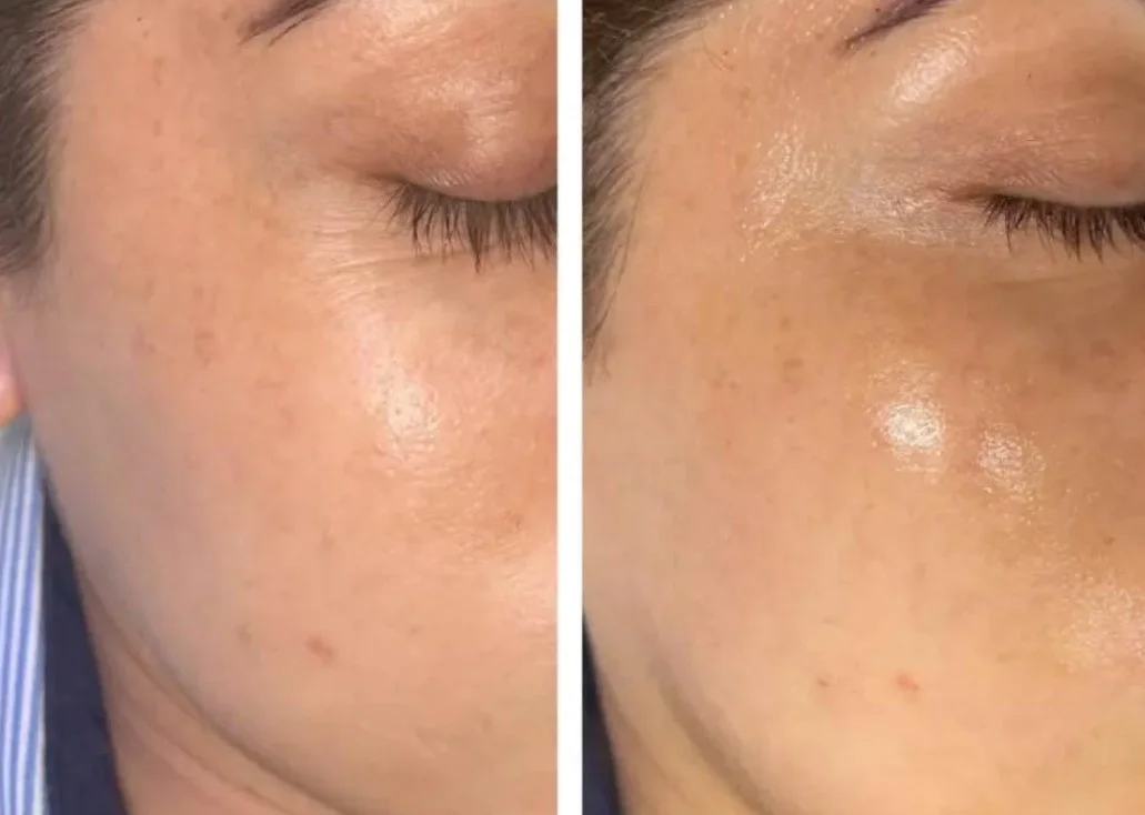 Close-up comparison of a person's cheek before and after skincare, showing reduced pigmentation and smoother skin in the after image.