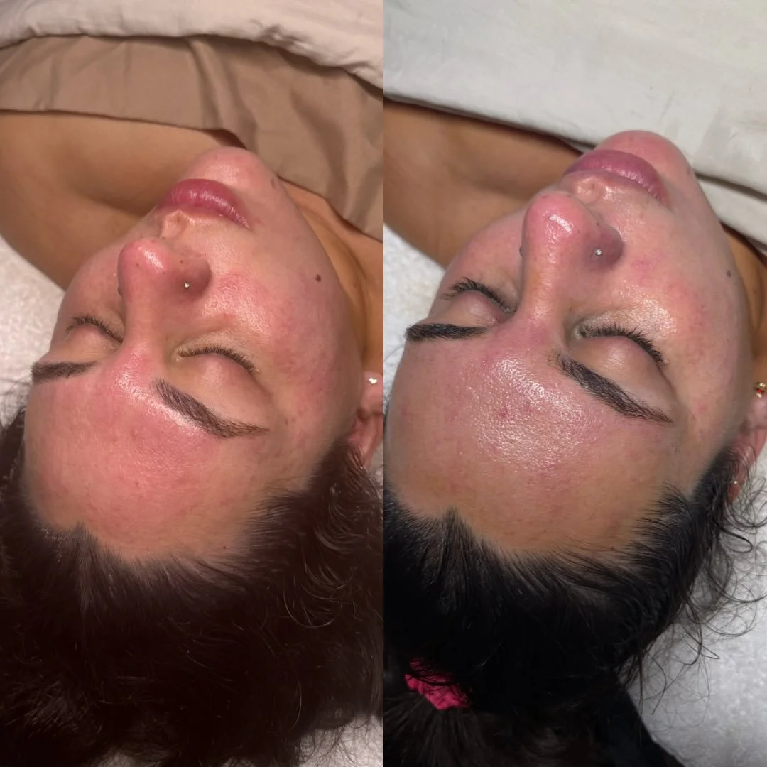 Consistency is key🗝️
Left: after first facial
Right: after third
Less redness, stronger barrier, calmer + glowier skin overall 🤎

#redlands #facials #facialist #healthyskin #glymedplus