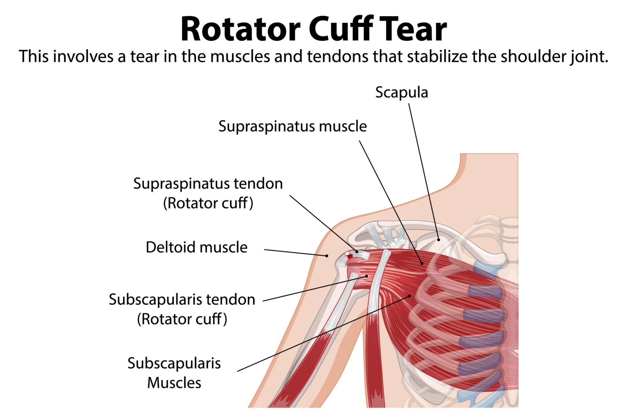 Diagram of shoulder muscles and tendons showing rotator cuff tear, with labels including supraspinatus muscle and tendon, scapula, deltoid muscle, and subscapularis tendon.