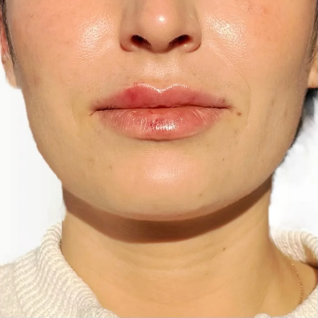 Nat&uuml;rlich wirkende Lippen entstehen nicht durch mehr Volumen &ndash; sondern durch ein Verst&auml;ndnis f&uuml;r Form, Bewegung und Proportion.

Bei dieser Patientin wirkte die Oberlippe beim Sprechen und Lachen kaum sichtbar, w&auml;hrend sie i