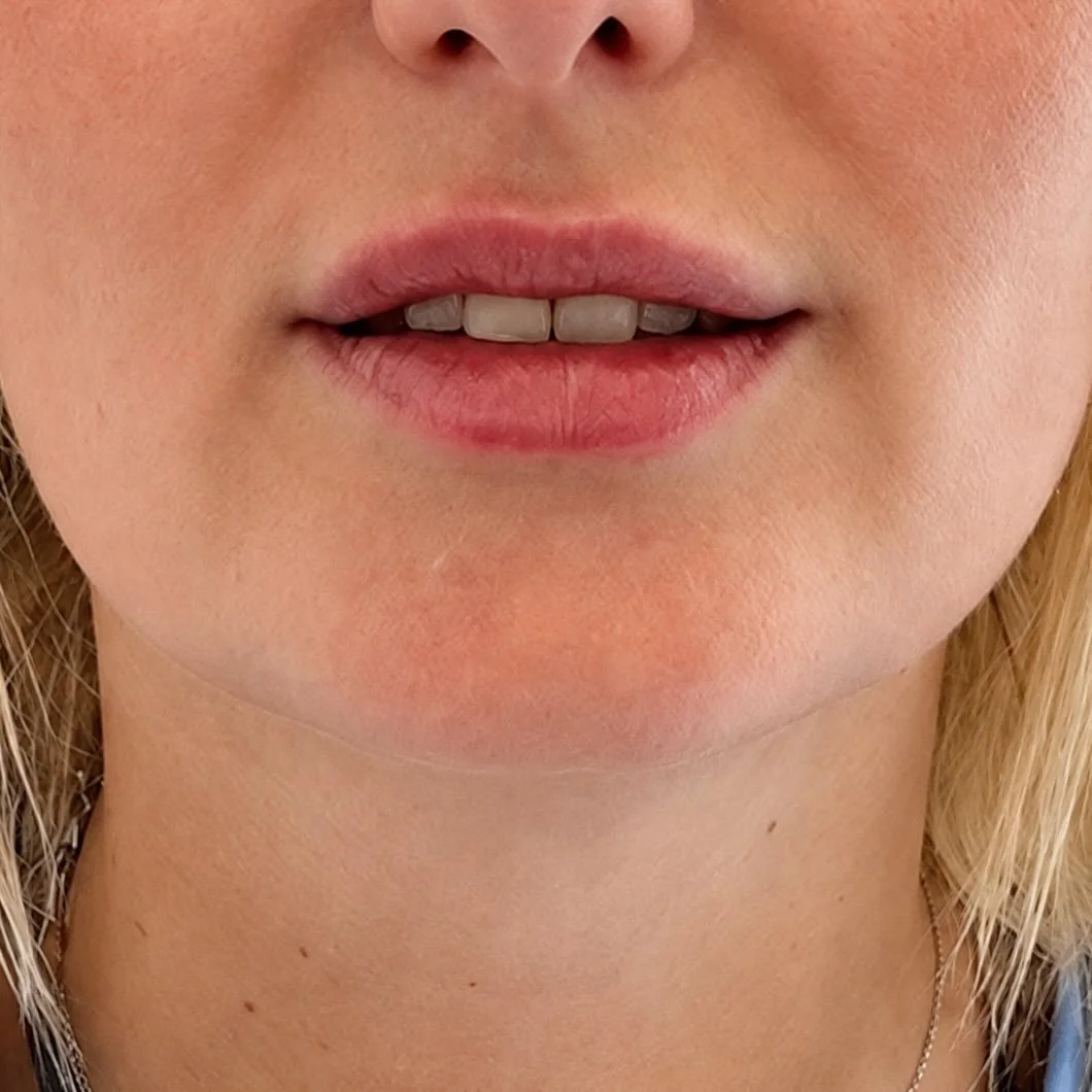 Ein harmonisches Ergebnis unterstreicht die eigene Sch&ouml;nheit, ohne &uuml;bertrieben zu wirken.

Das Ergebnis zwei Wochen nach einem Lippenaufbau mit Hyalurons&auml;ure:

Frisch. Dezent. Nat&uuml;rlich.

👉 Hinweis: Aus rechtlichen Gr&uuml;nden w