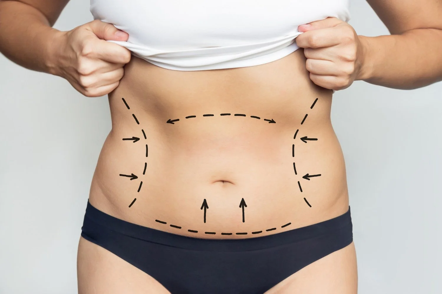 What to Know Before Getting a Tummy Tuck in Orlando