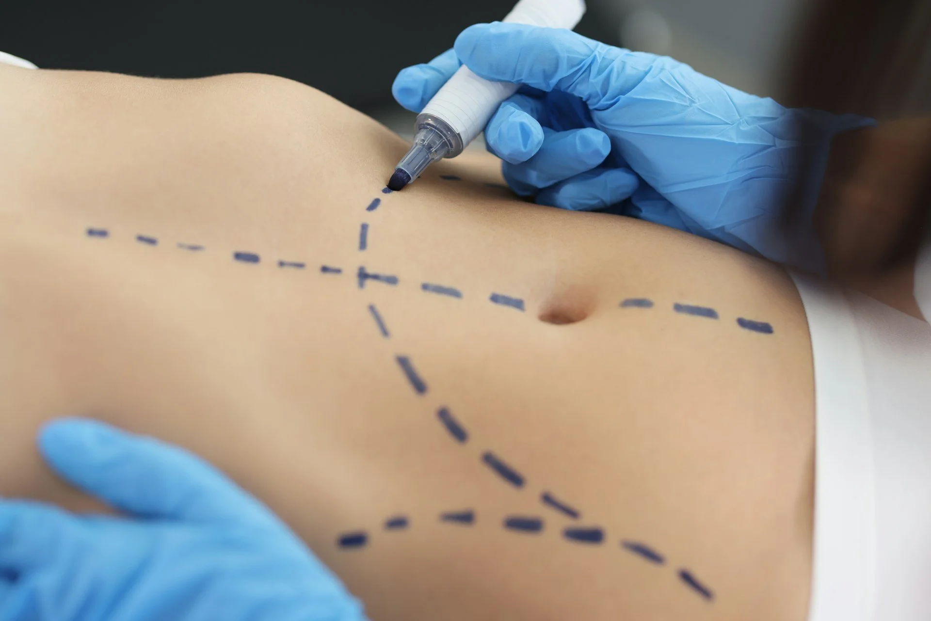 Discover The Benefits Of Fat Transfer In Orlando For Natural Contour