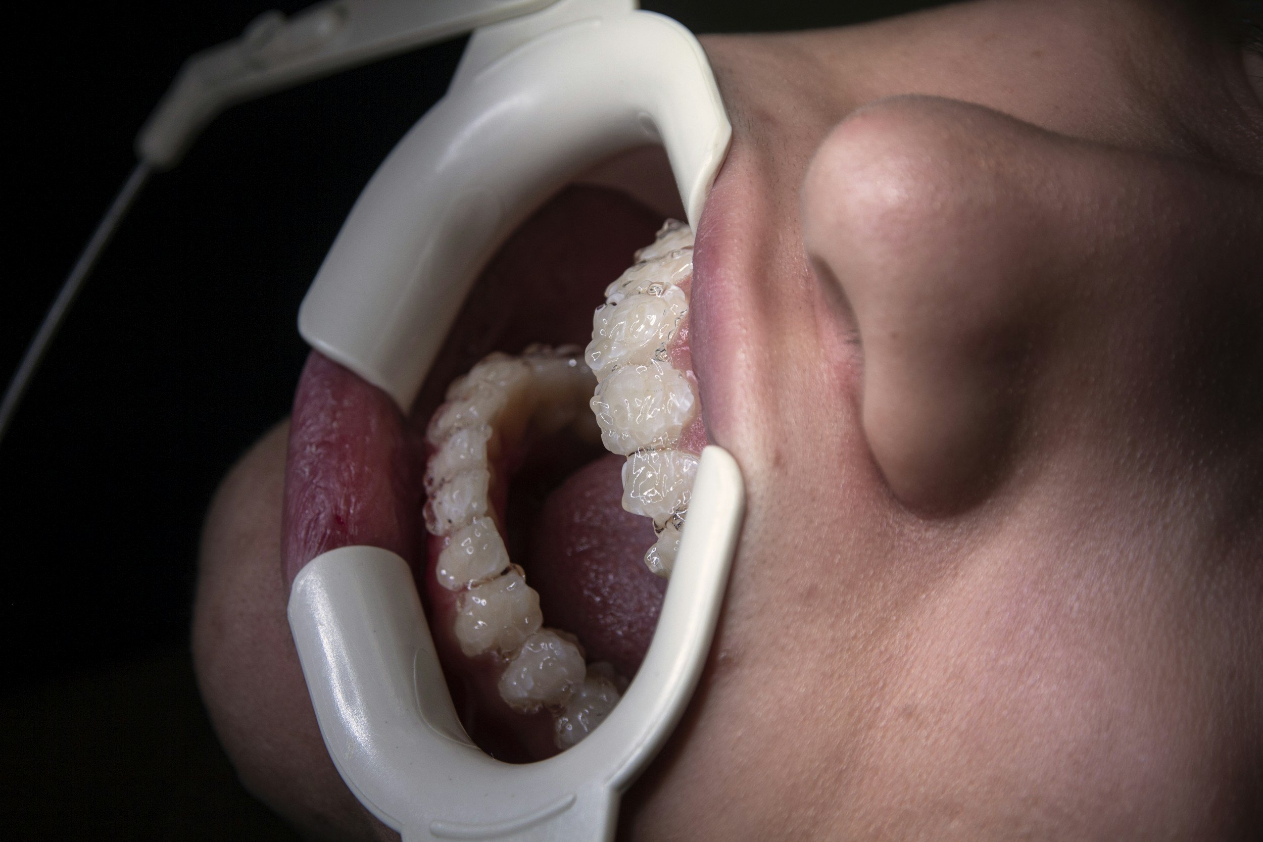 Close-up of a person with mouth open, wearing a dental cheek retractor, mouth guard, with teeth exposed for dental examination or cleaning.