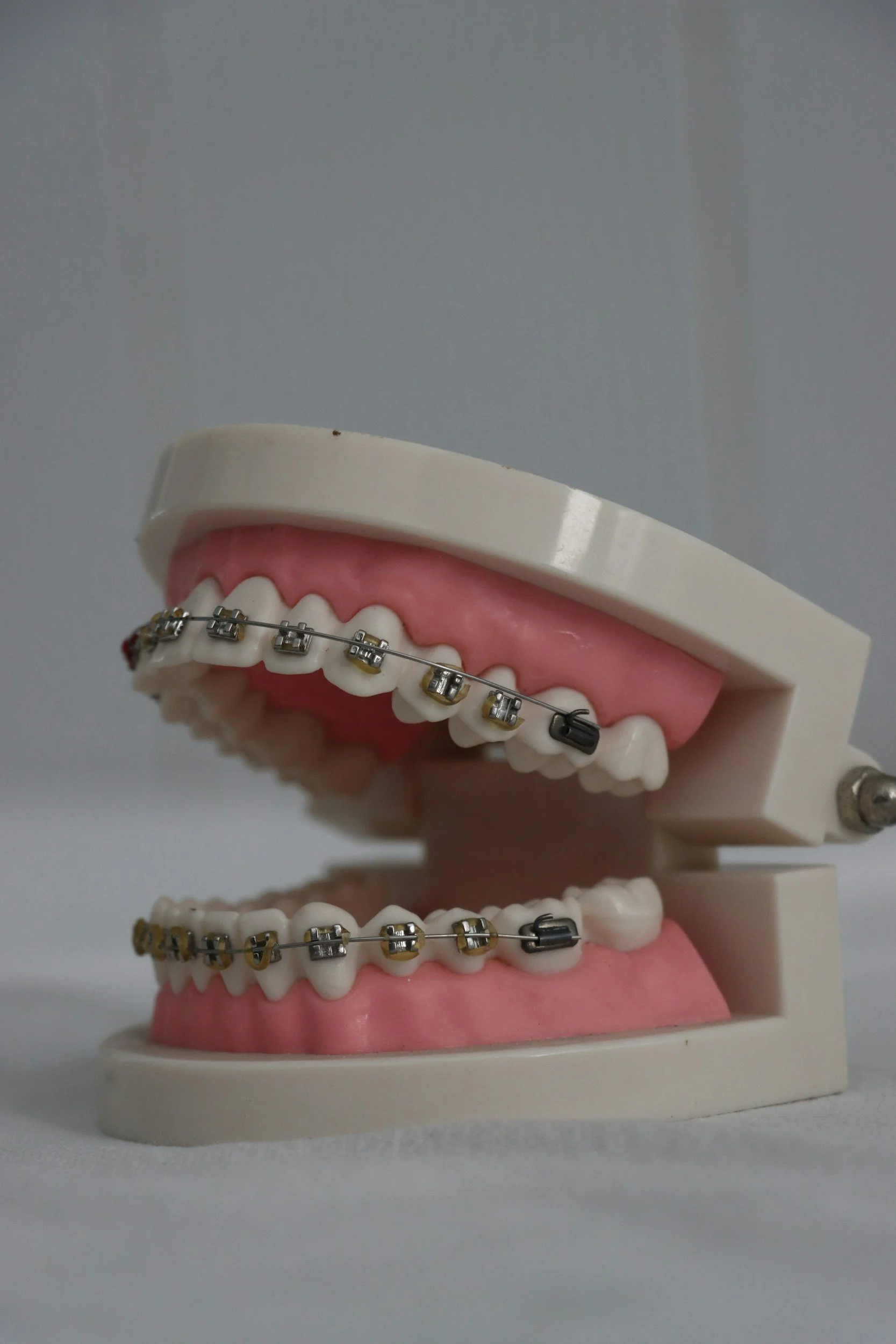 A dental model showing the upper and lower teeth with braces.