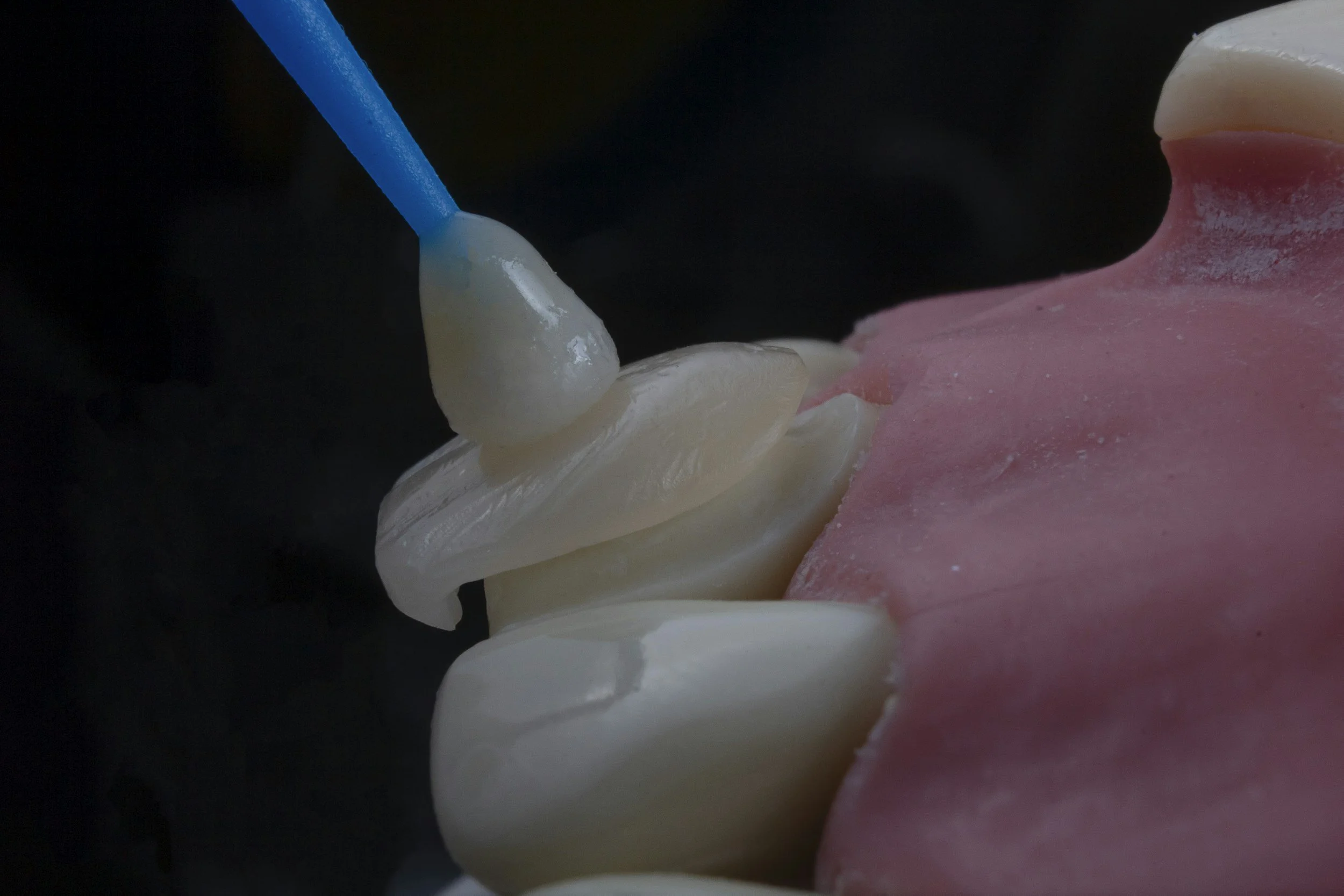 Close-up of a toothbrush applying white dental cement or filling material to damaged tooth with pink dental impression material in the background.