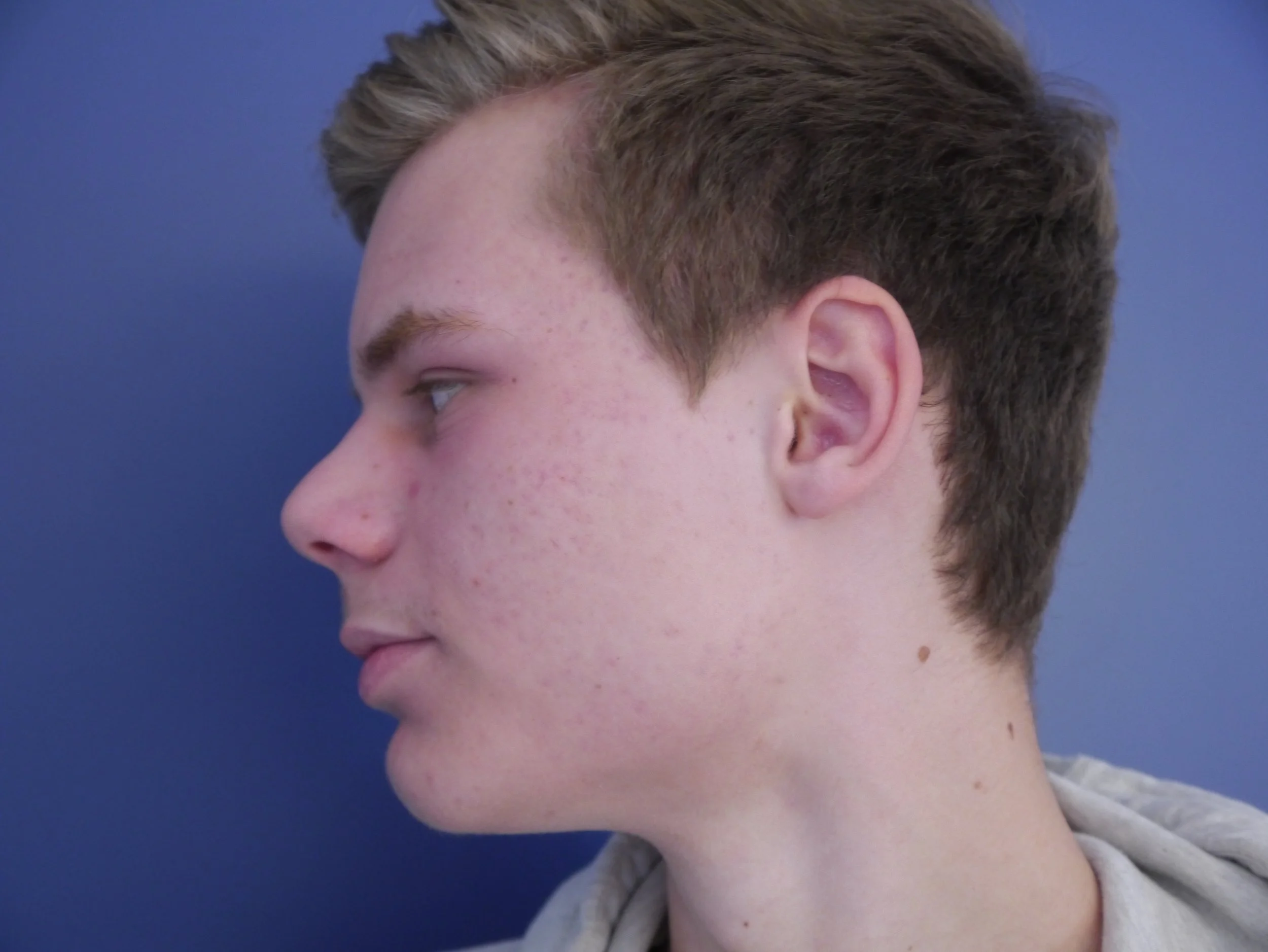 Acne facial treatment using ZO Skin Health products in Nosara