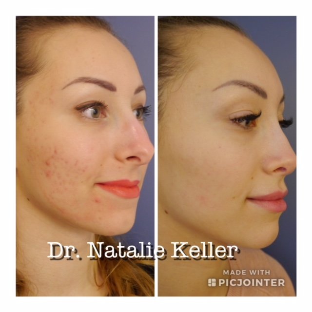 Acne facial treatment using ZO Skin Health products in Nosara