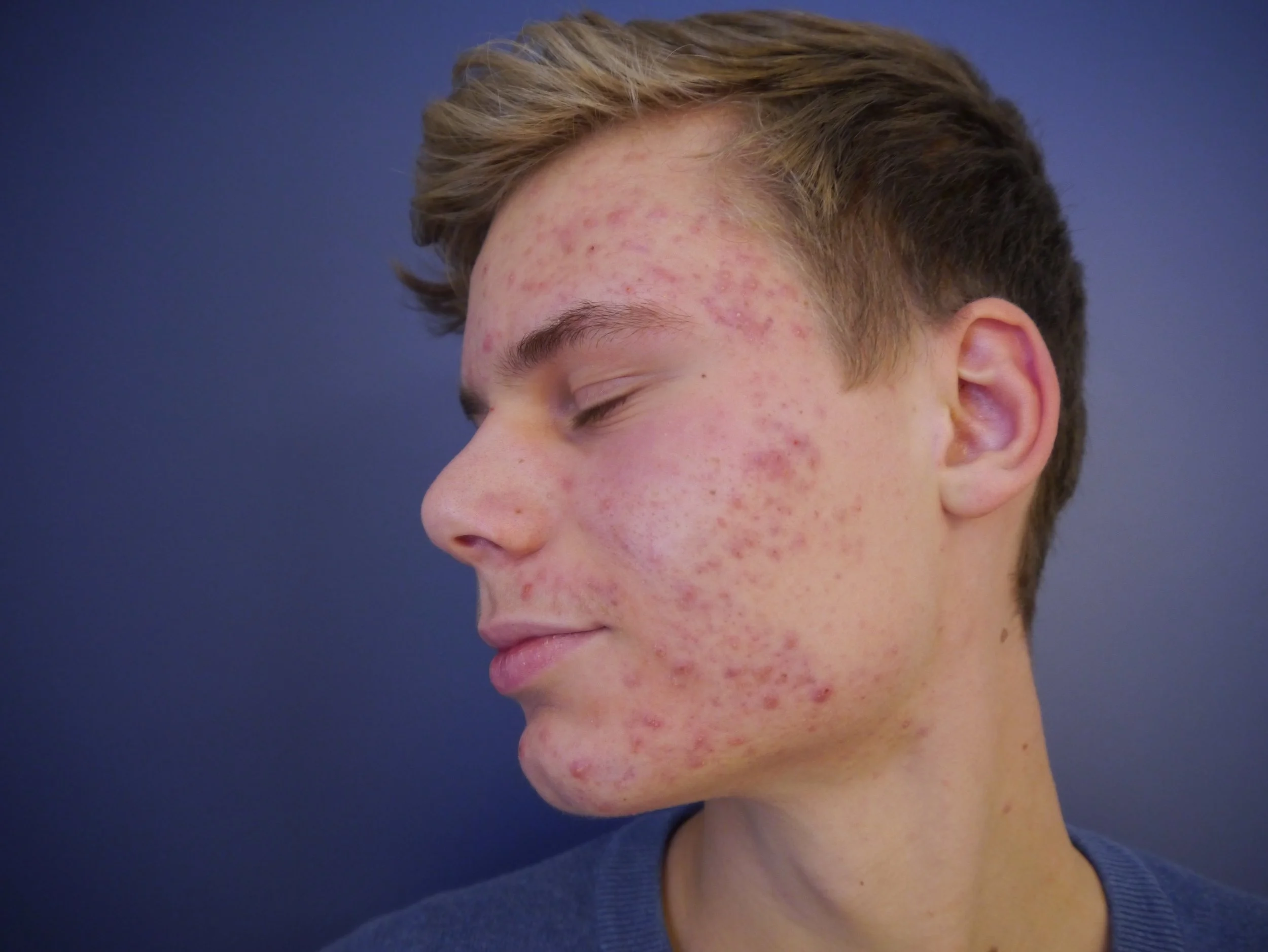 Acne facial treatment using ZO Skin Health products in Nosara