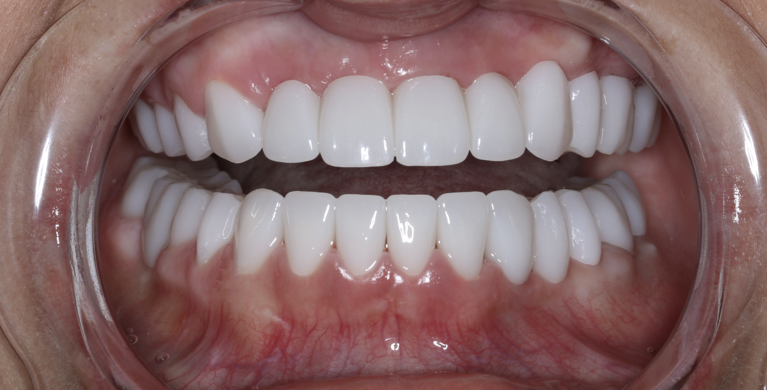 Close-up of a person's open mouth with a dental retractor, showing clean, white upper and lower teeth.