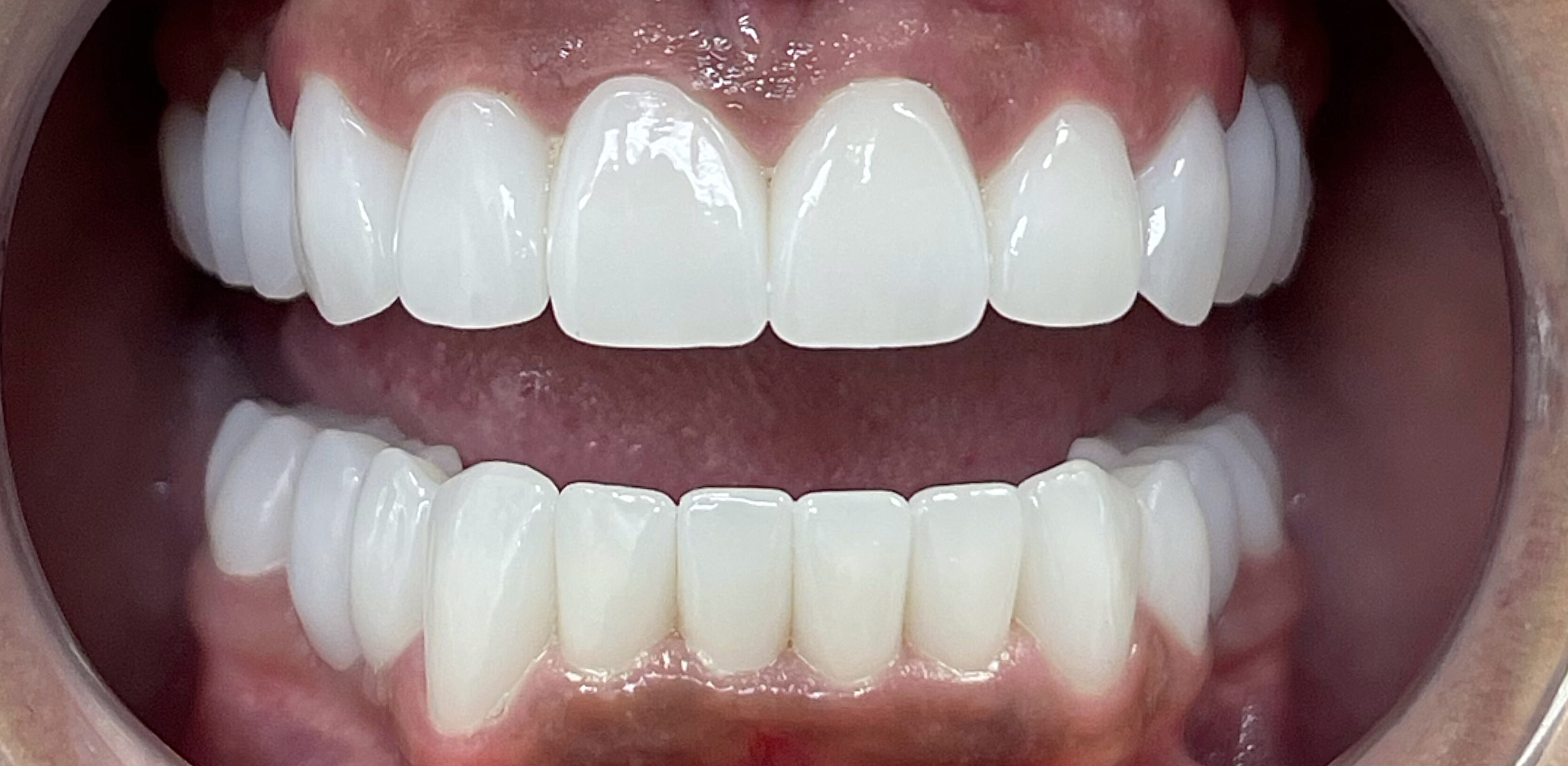 Close-up of a person's open mouth showing clean, white teeth and healthy gums.
