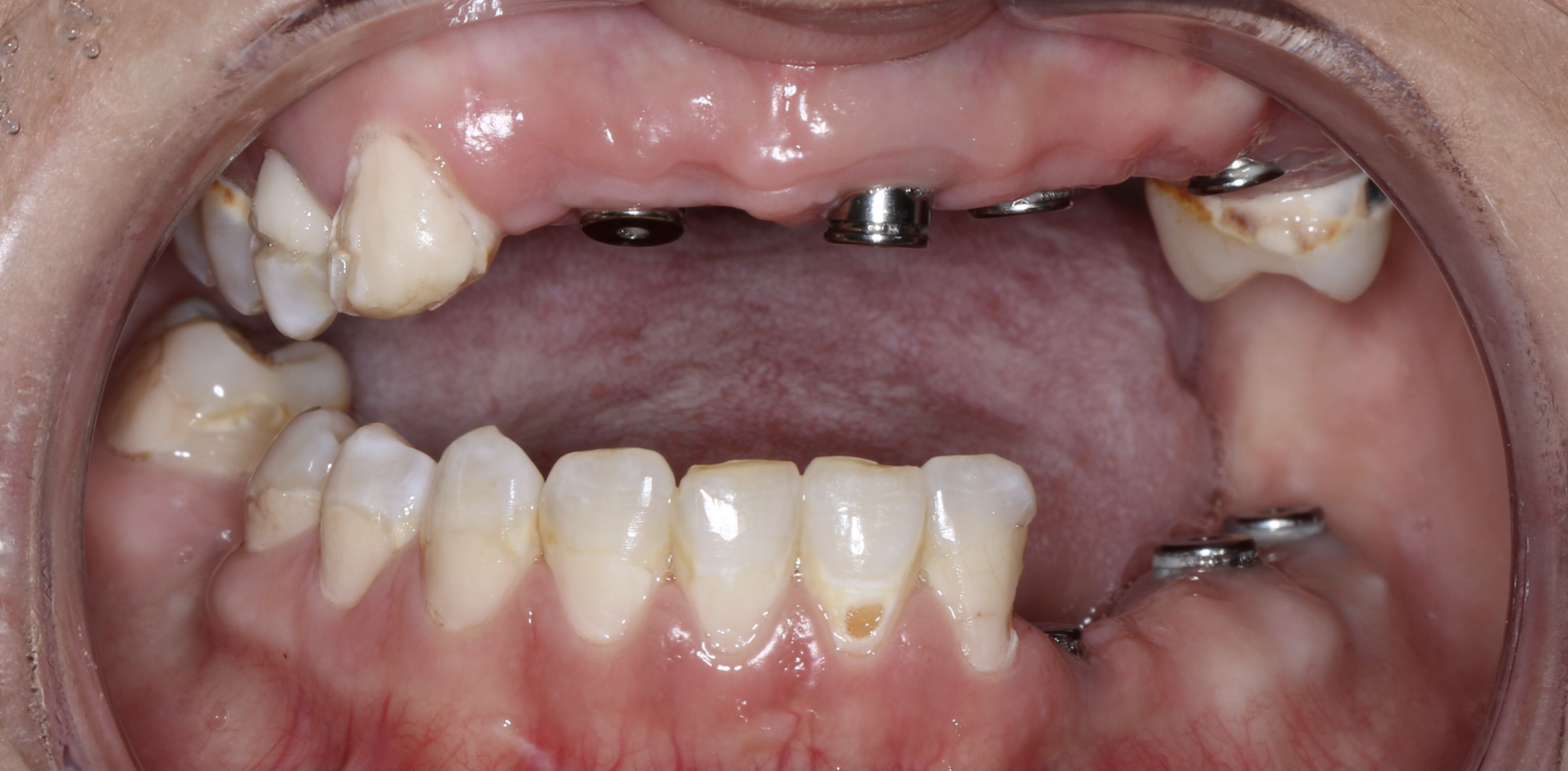 Close-up of a person's open mouth showing dental implants with metal abutments, decayed teeth, and plaque buildup on remaining teeth.