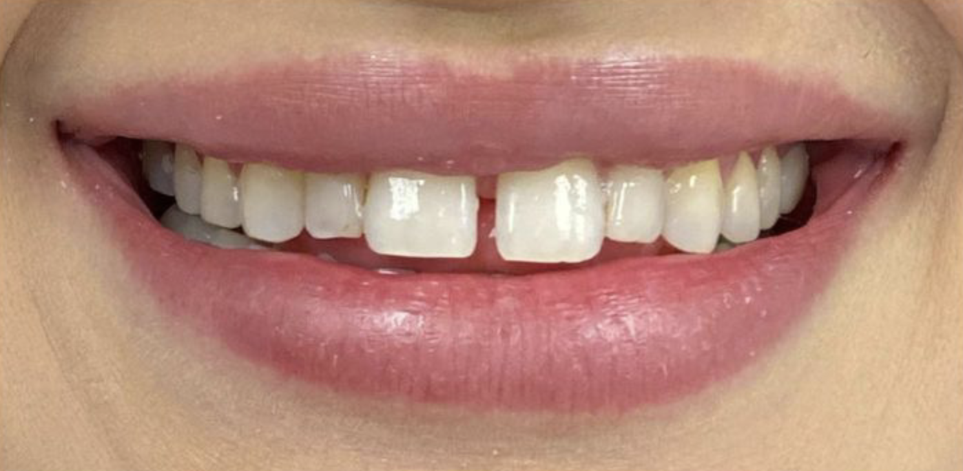 Close-up of a person's mouth smiling showing irregular, chipped, and misaligned teeth.