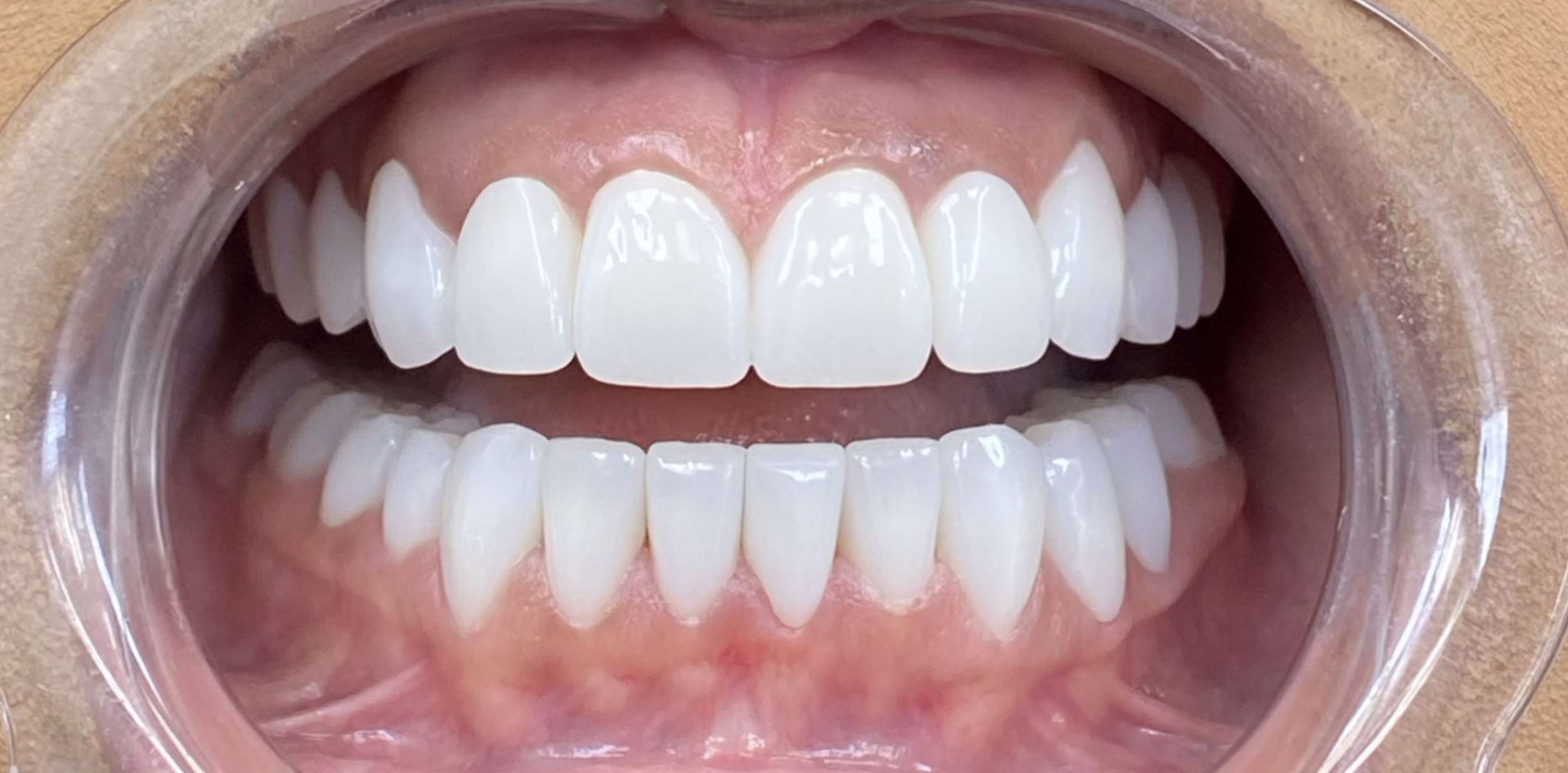 Close-up of a person's open mouth showing clean, white teeth with a dental cheek retractor in place.