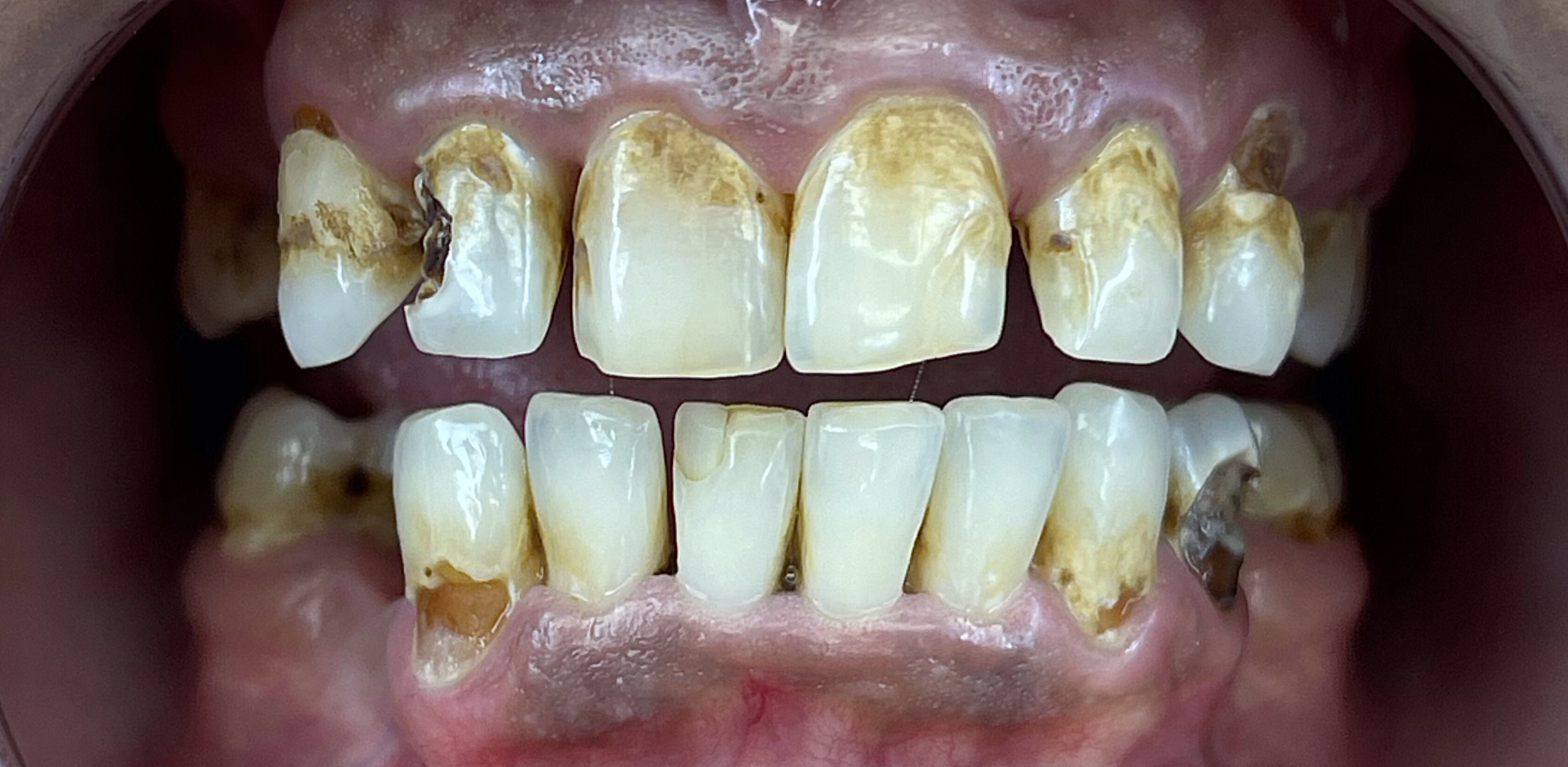 Close-up of severely decayed and discolored teeth with tooth decay and plaque buildup.