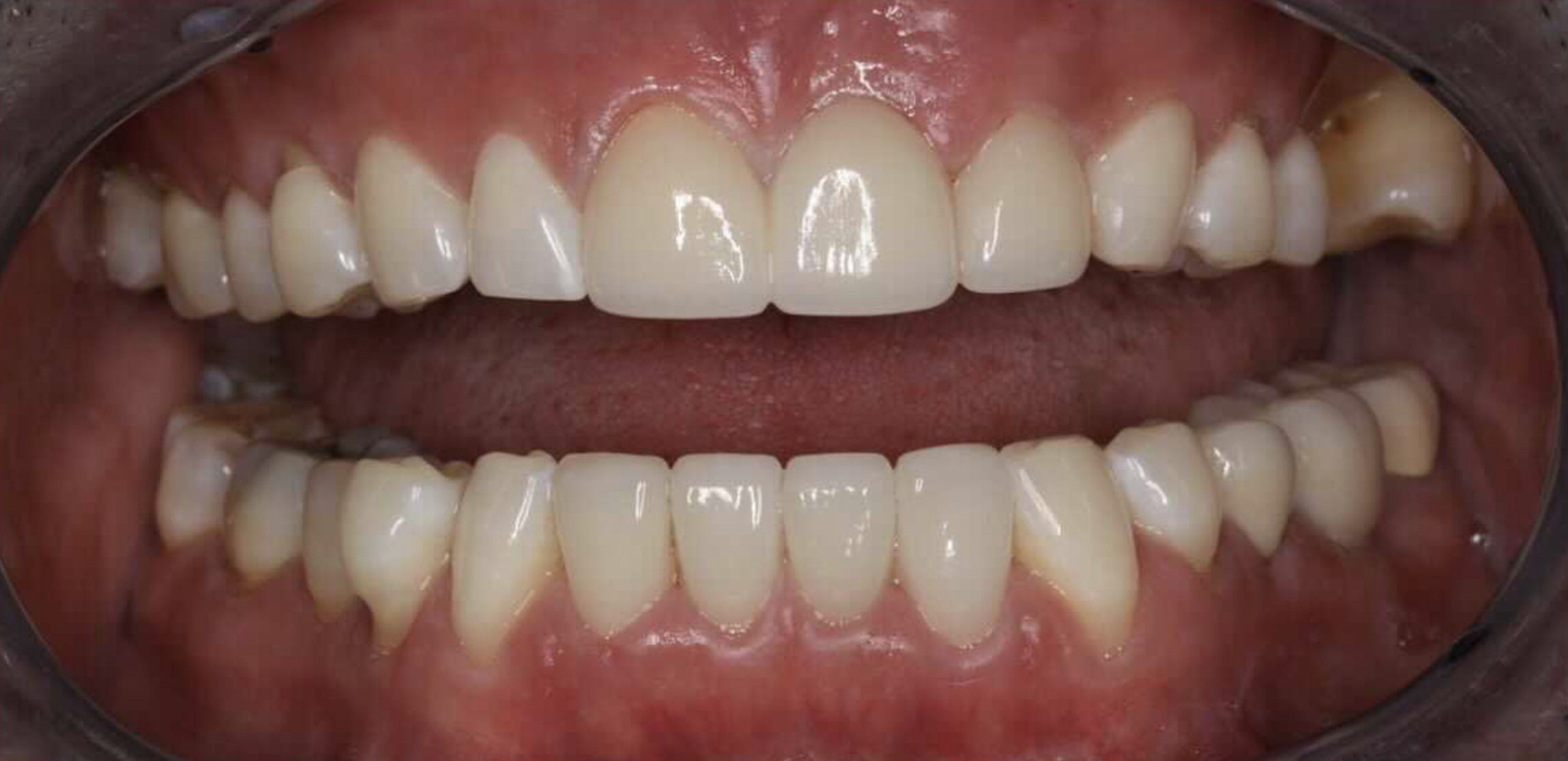 Close-up of open mouth showing upper and lower teeth with healthy gums