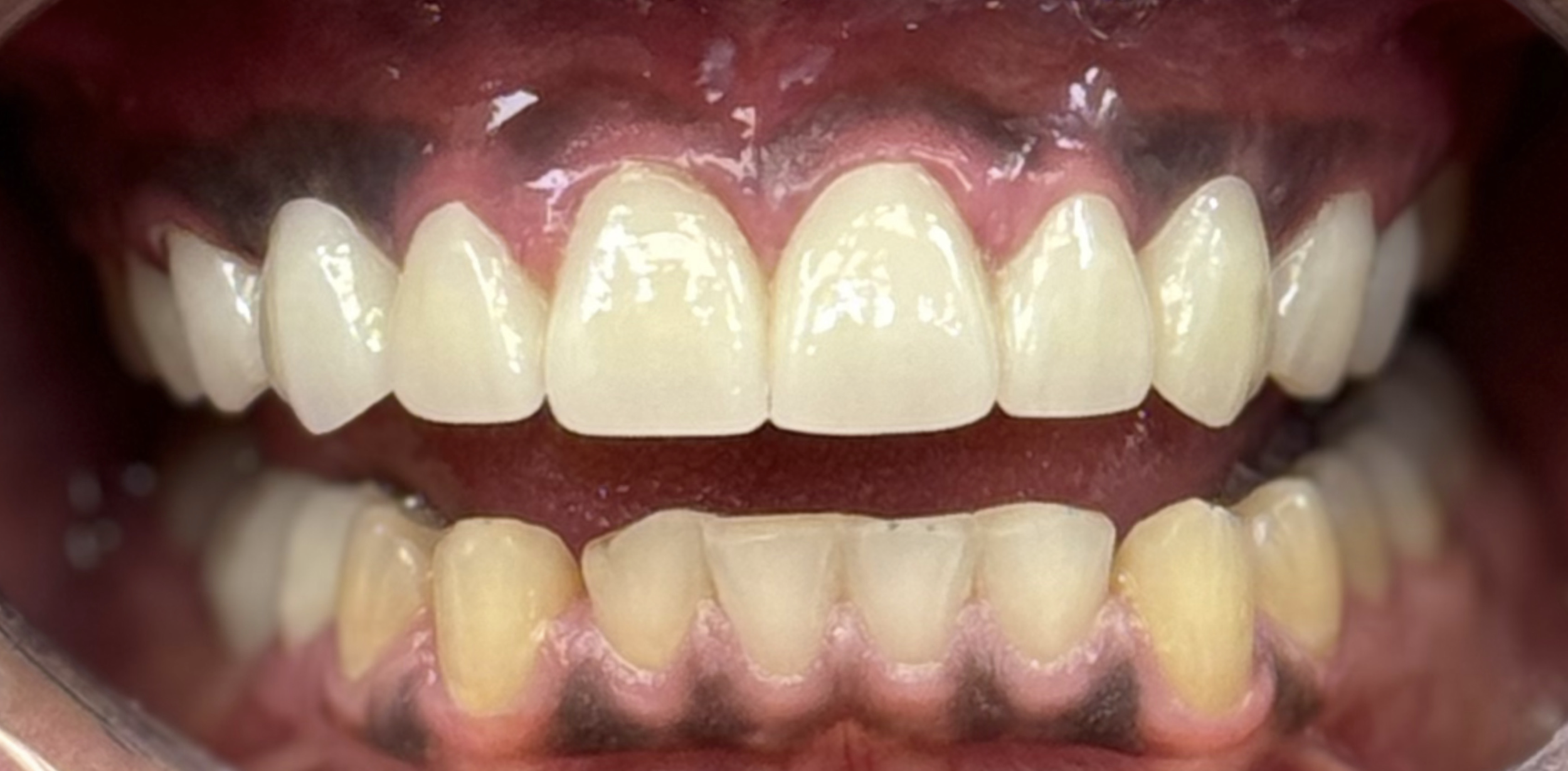 Close-up of a person's mouth showing upper and lower teeth. The teeth are slightly yellowed, and the gums are visible.