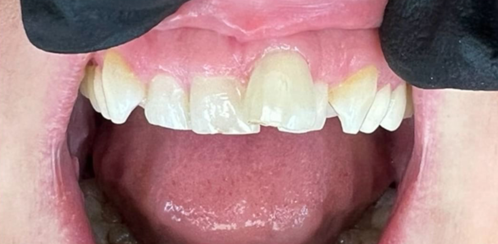 Close-up of a person's open mouth showing discolored and chipped upper front teeth with visible staining and plaque.